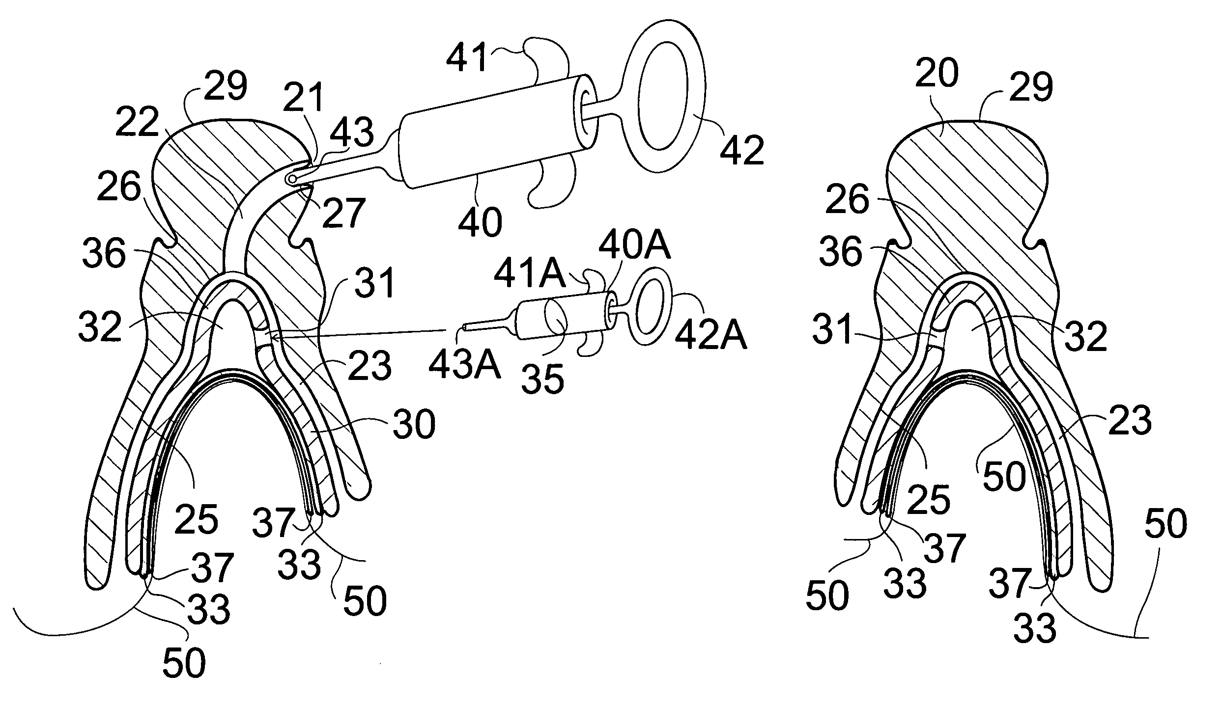 Vacuum-seated dentures with skin contacting plate