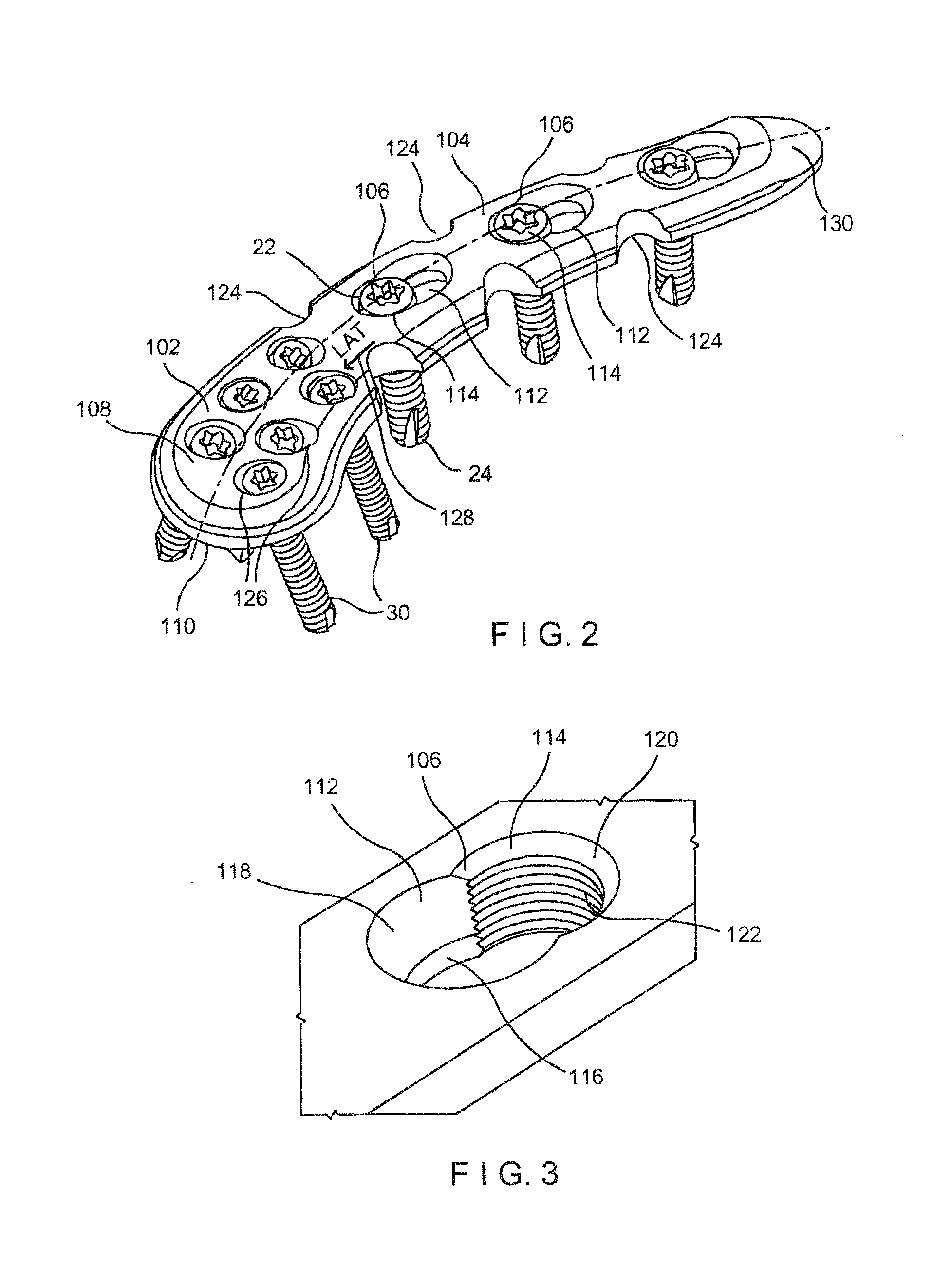 System and Method for Minimally Invasive Clavicle Plate Application