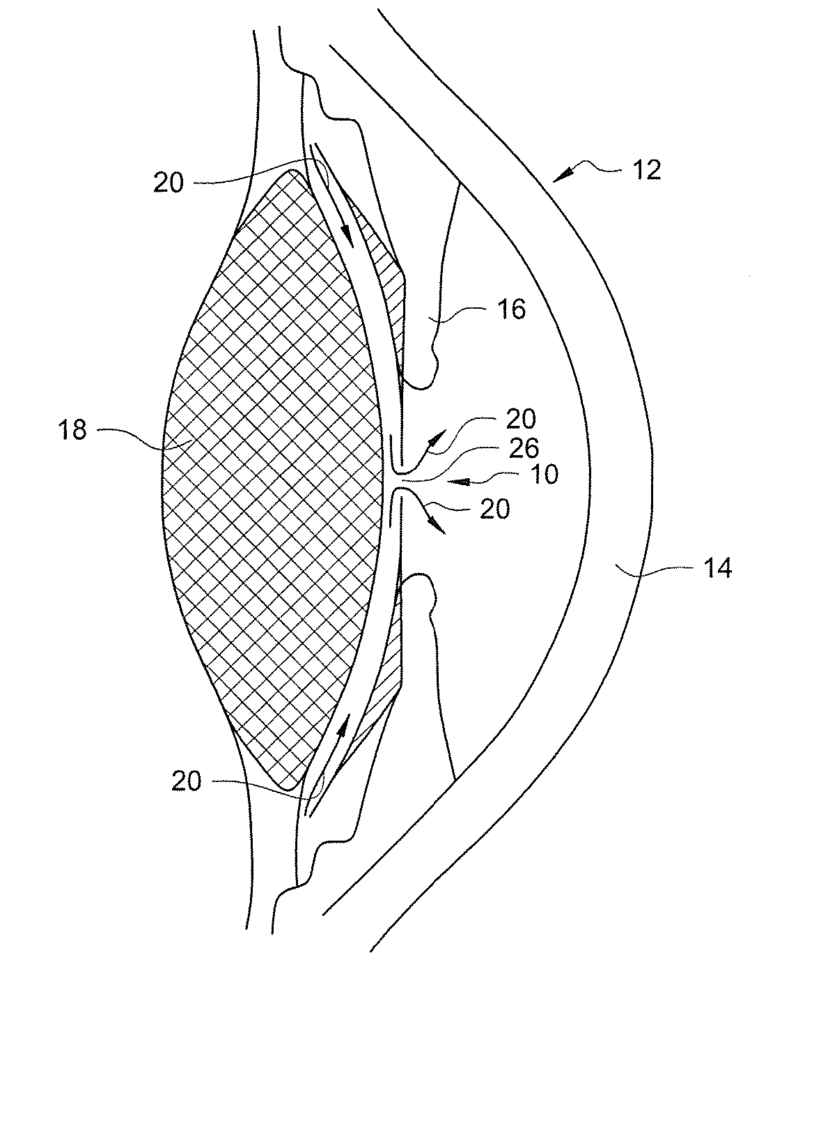 Posterior chamber Phakic Intraocular Lens