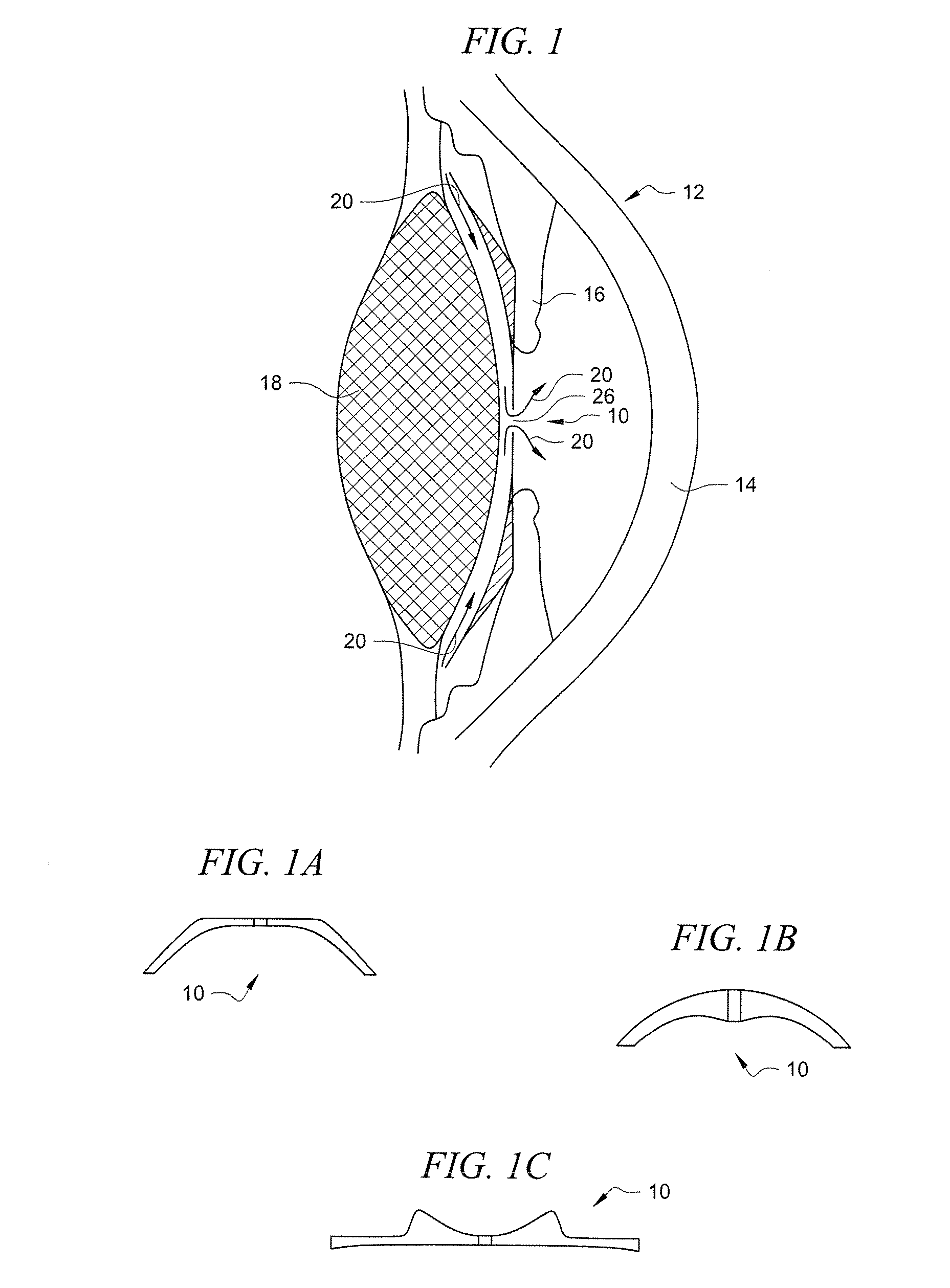 Posterior chamber Phakic Intraocular Lens