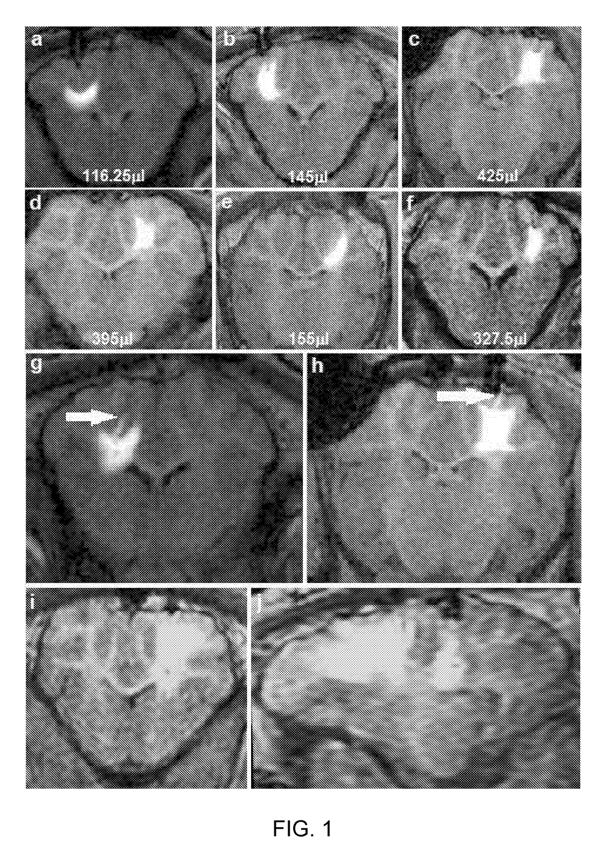 Delivery of a therapeutic agent to the cerebral cortex by administering a viral vector by convection enhanced diffusion into the white matter of the brain