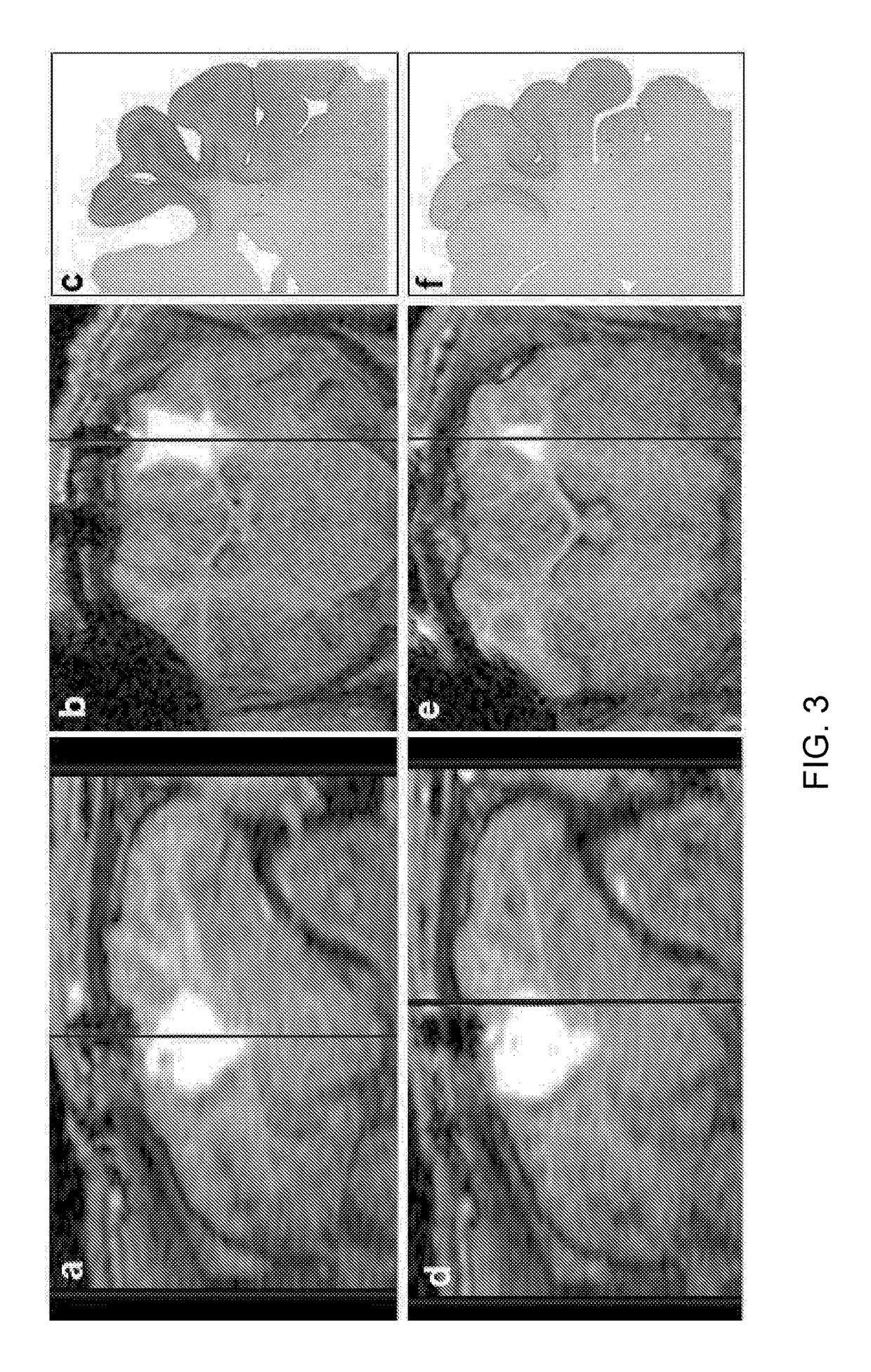 Delivery of a therapeutic agent to the cerebral cortex by administering a viral vector by convection enhanced diffusion into the white matter of the brain