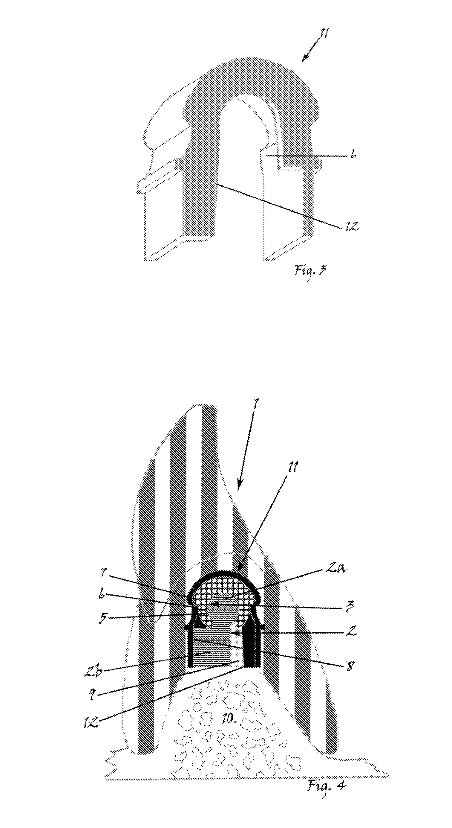 Precision attachment system with indirect retainer