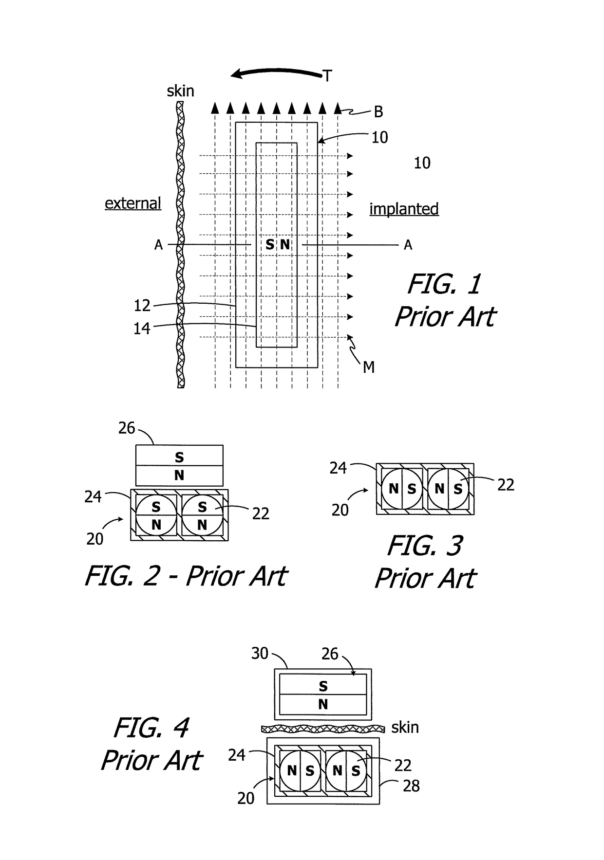 Cochlear implants having MRI-compatible magnet apparatus and associated methods