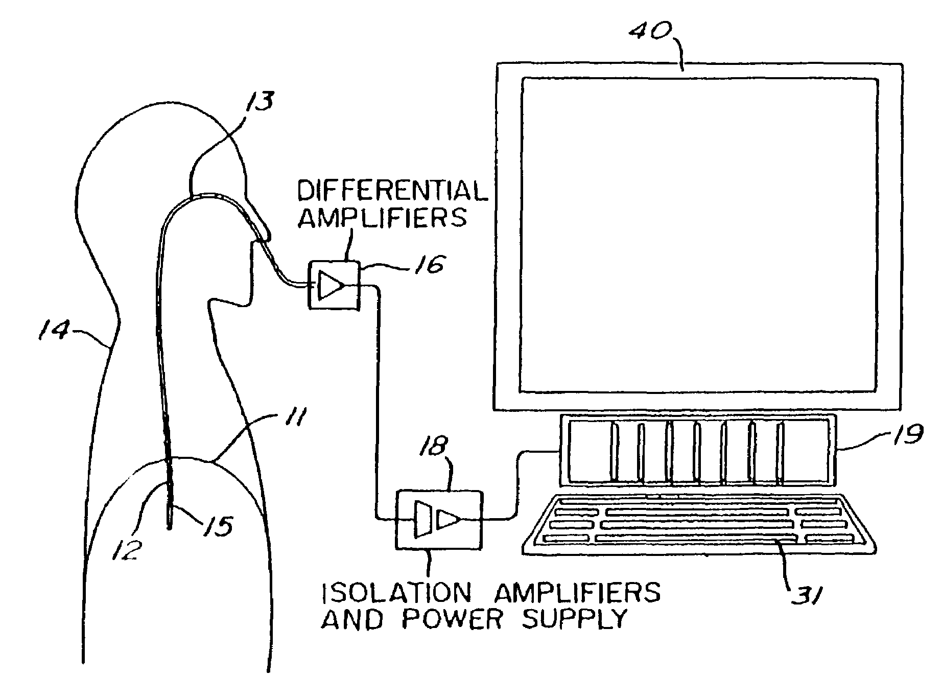 Proportional pressure assist ventilation controlled by a diaphragm electromyographic signal