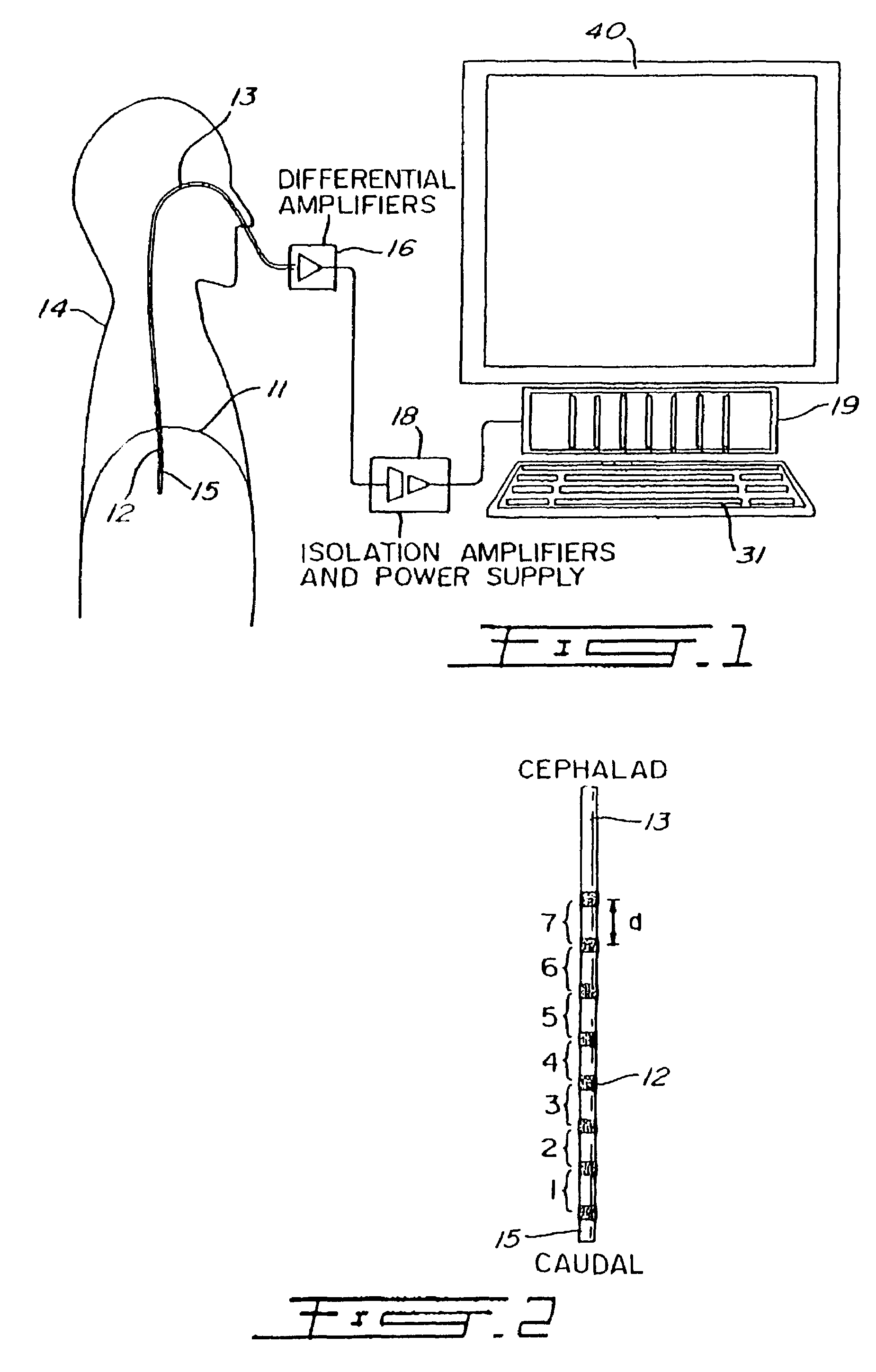 Proportional pressure assist ventilation controlled by a diaphragm electromyographic signal