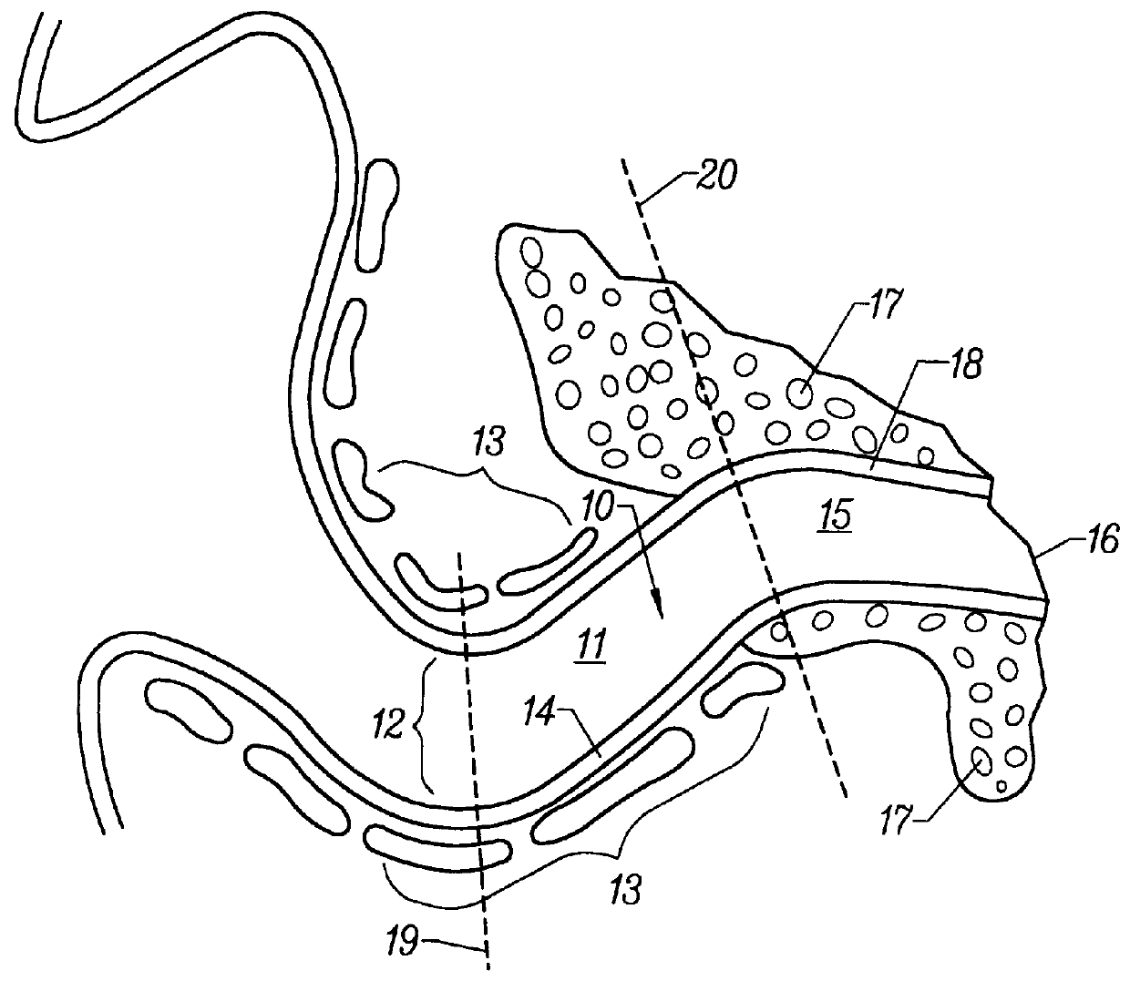 Minimal contact replaceable acoustic coupler