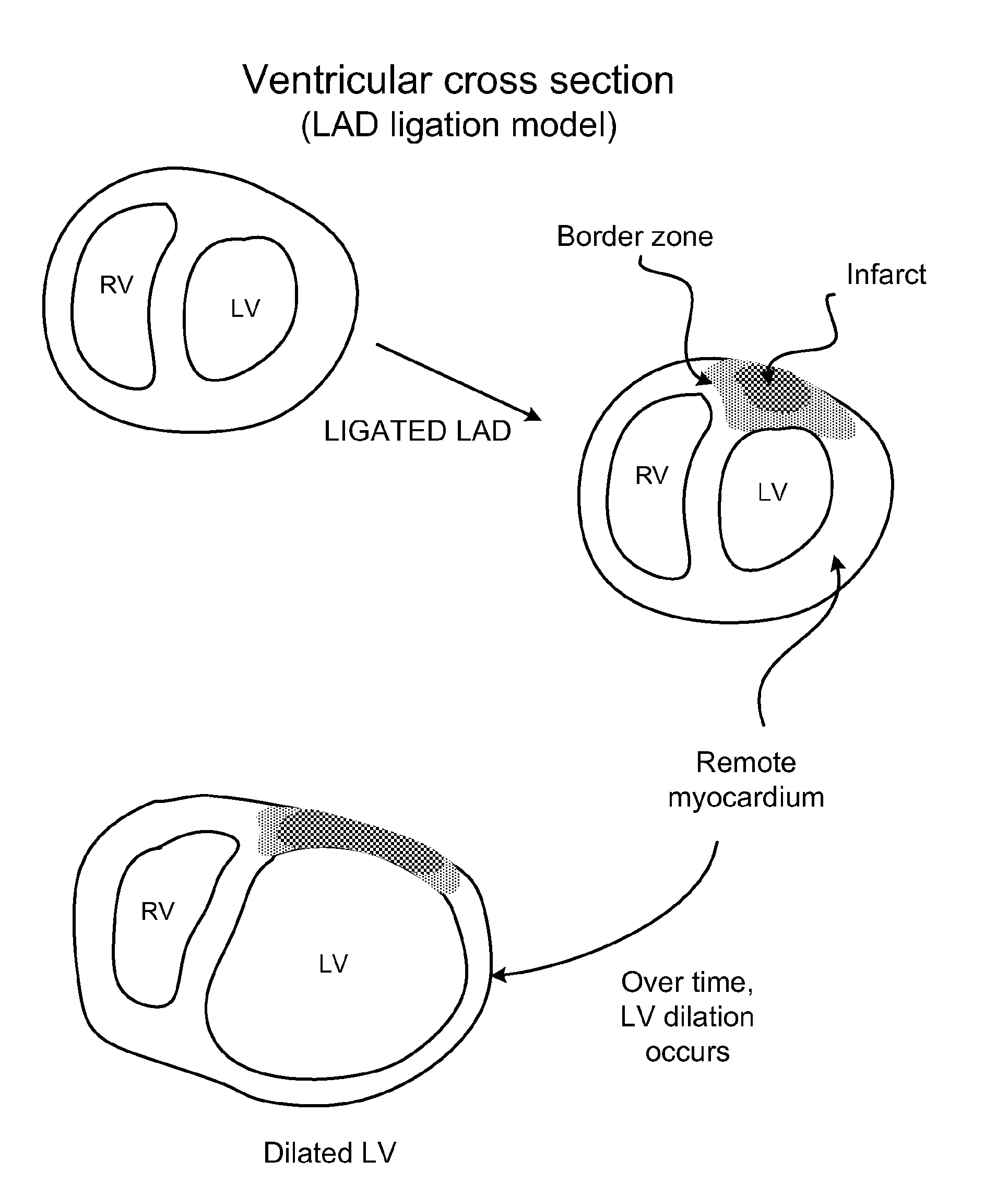 Methods and compositions for inhibiting progression to chronic cardiac failure