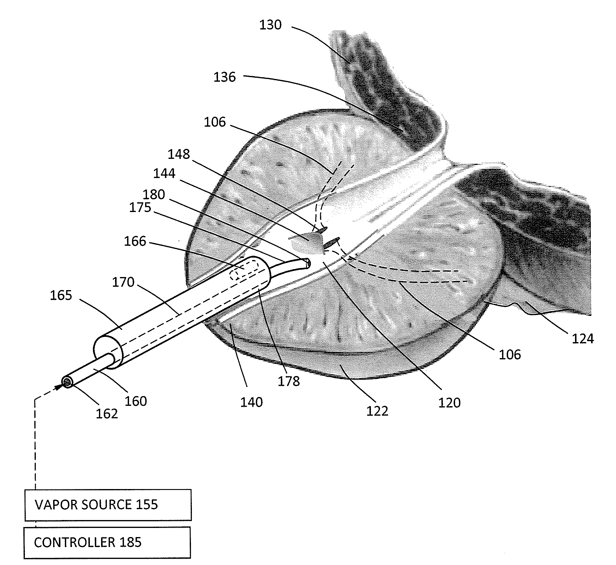 Systems and methods for male sterilization