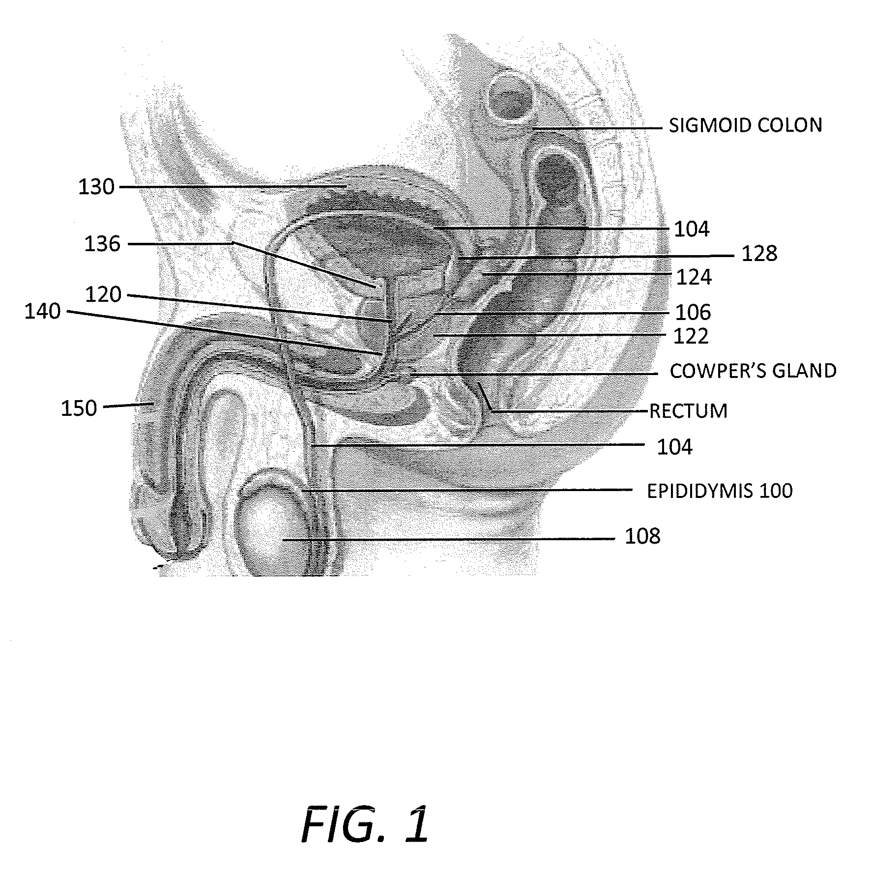 Systems and methods for male sterilization