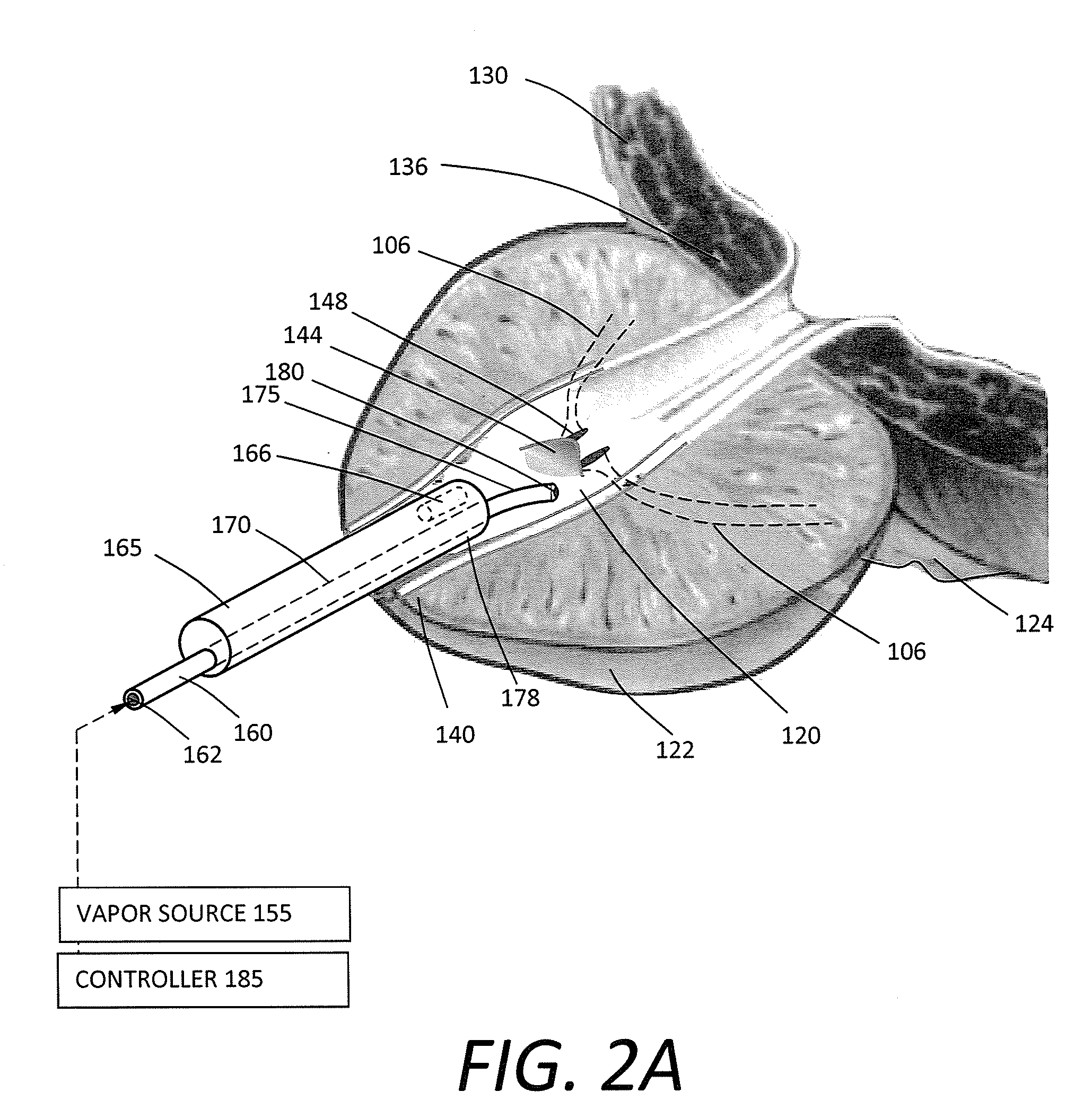 Systems and methods for male sterilization