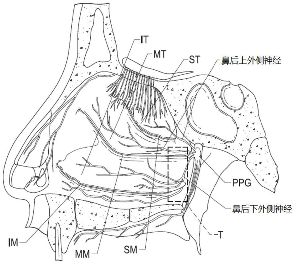 Devices and related methods and systems for therapeutic nasal neuromodulation