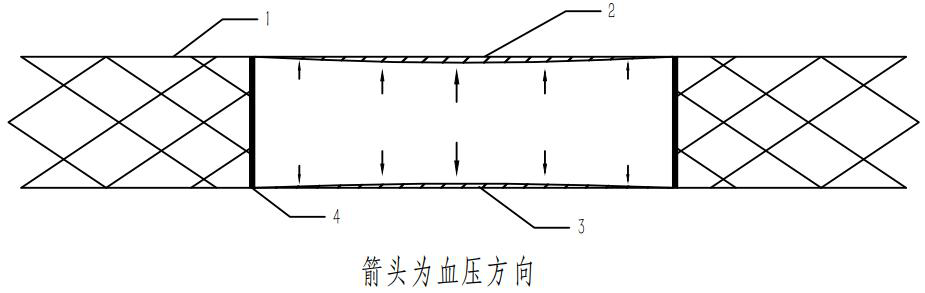 TIPS covered stent capable of automatically adjusting blood flow pressure