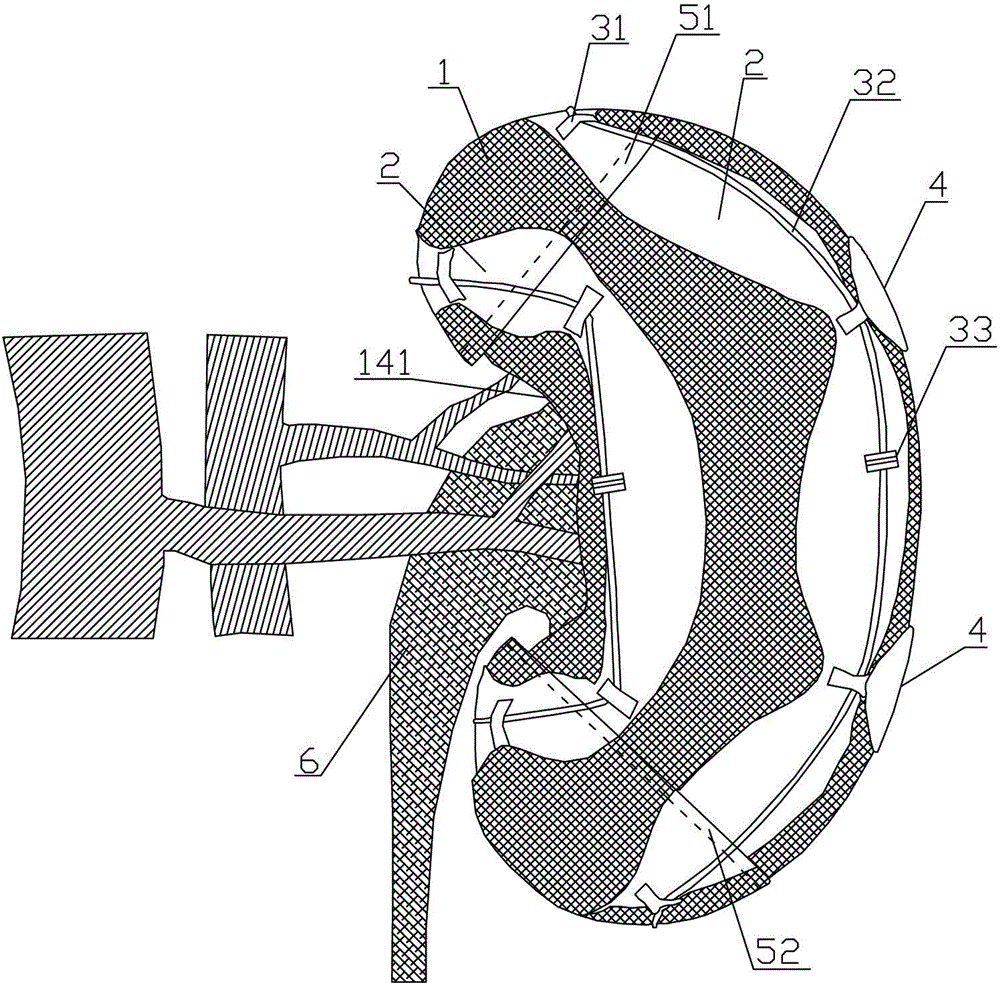 Kidney canula device for treating kidney rupture and using method thereof