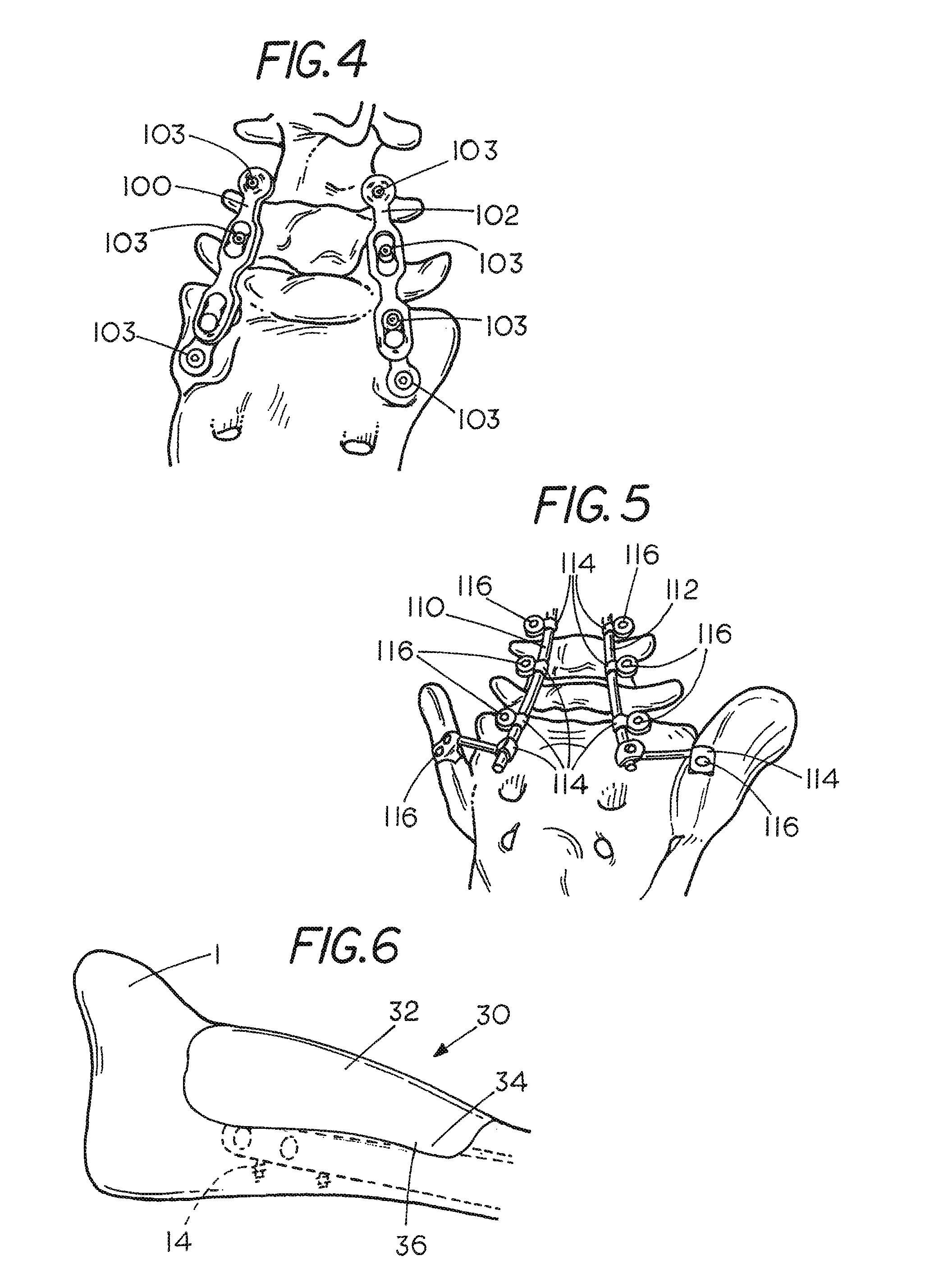 Moldable cushion for implants