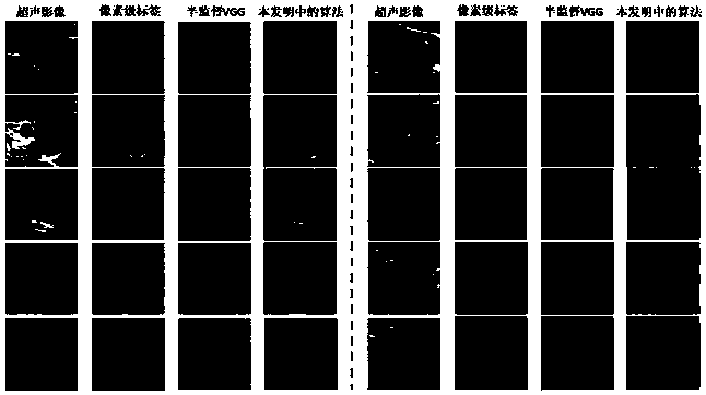 Thyroid nodule semi-supervised segmentation method based on attention mechanism