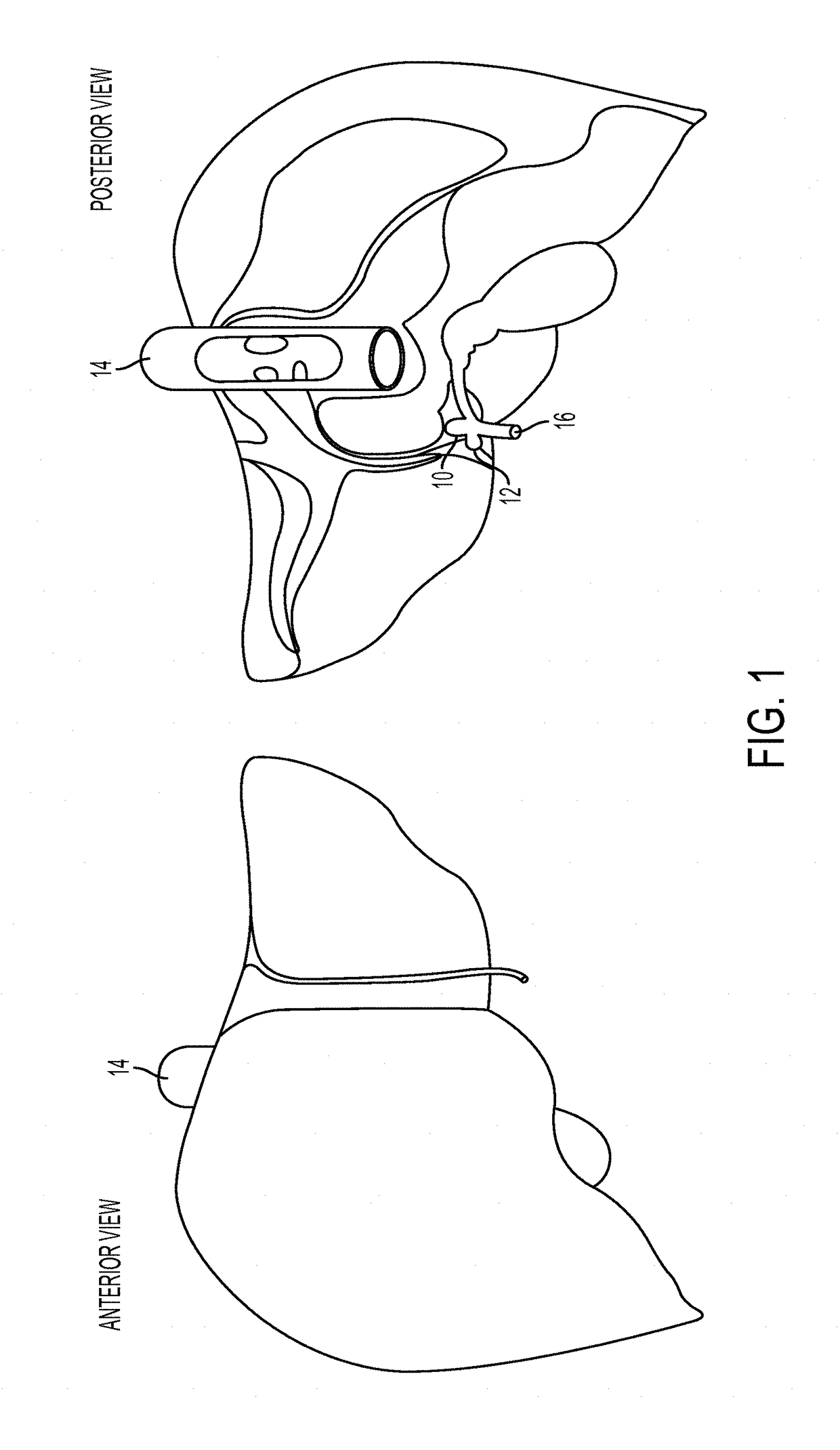 Ex vivo organ care system