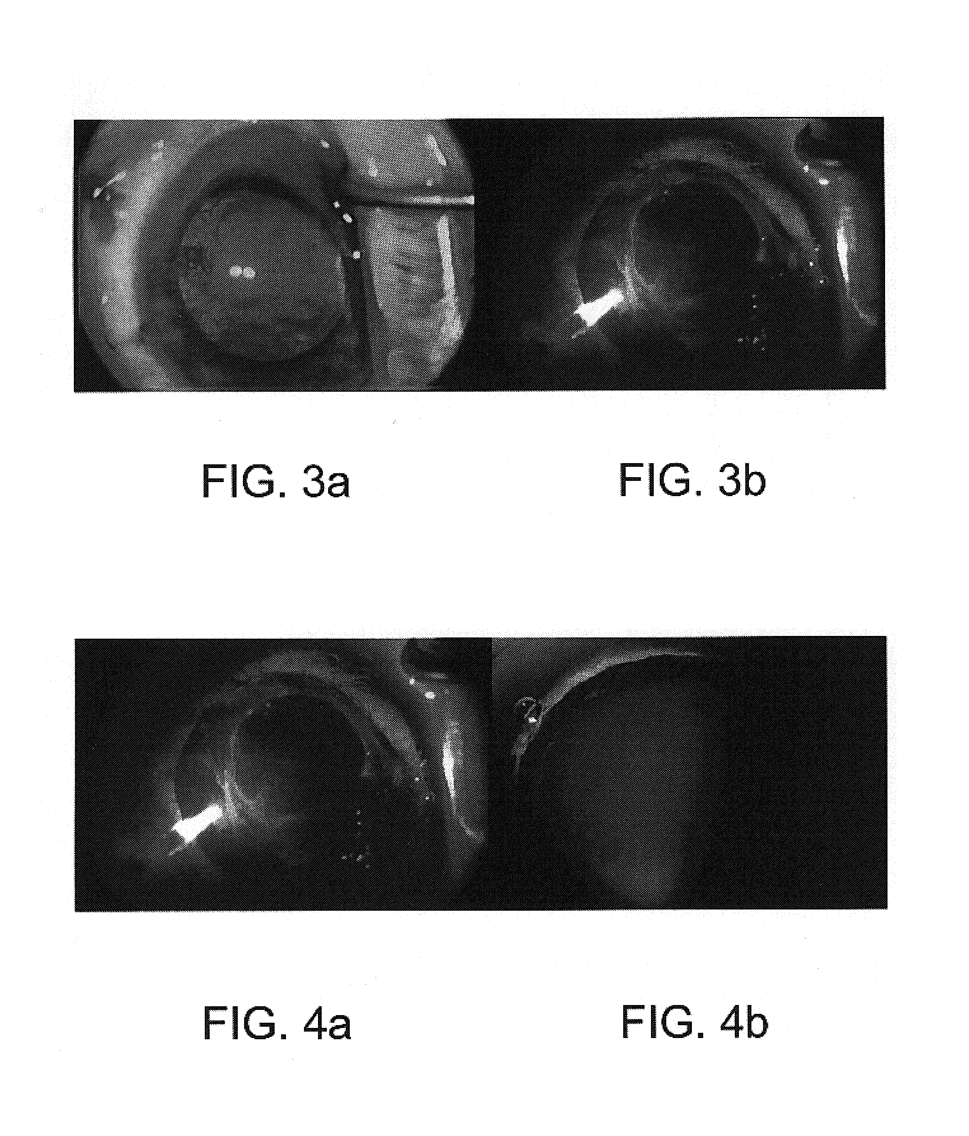 Shielded intraocular probe for improved illumination or therapeutic application of light