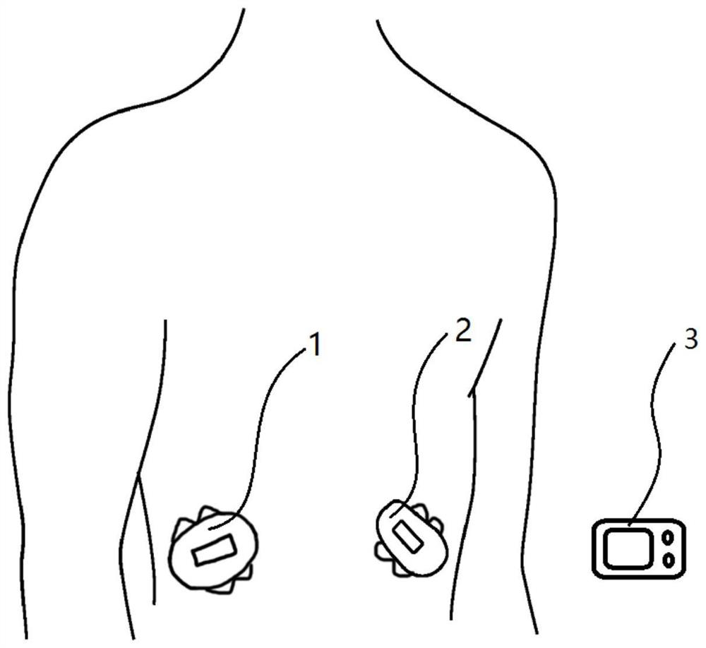 A system and method for closed-loop control of artificial pancreas