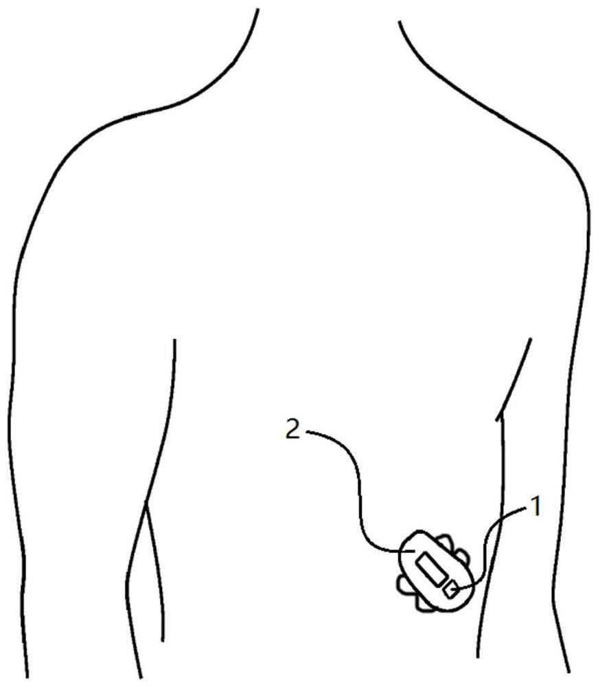 A system and method for closed-loop control of artificial pancreas