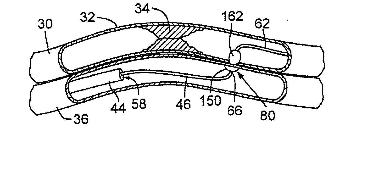 Catheter system for connecting adjacent blood vessels