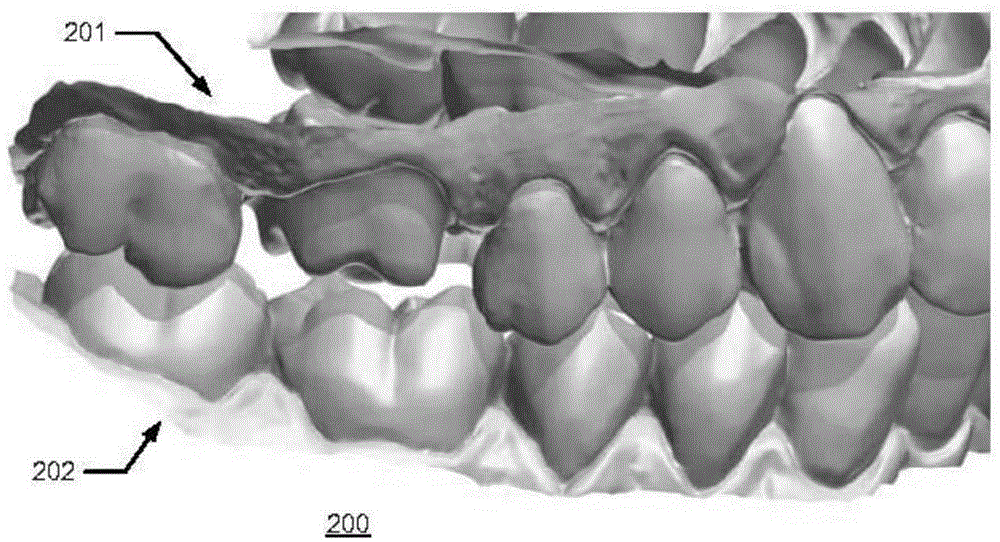 Multiple bite configurations