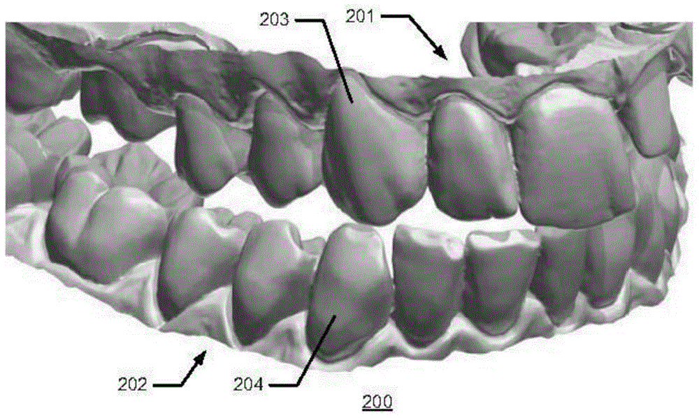 Multiple bite configurations