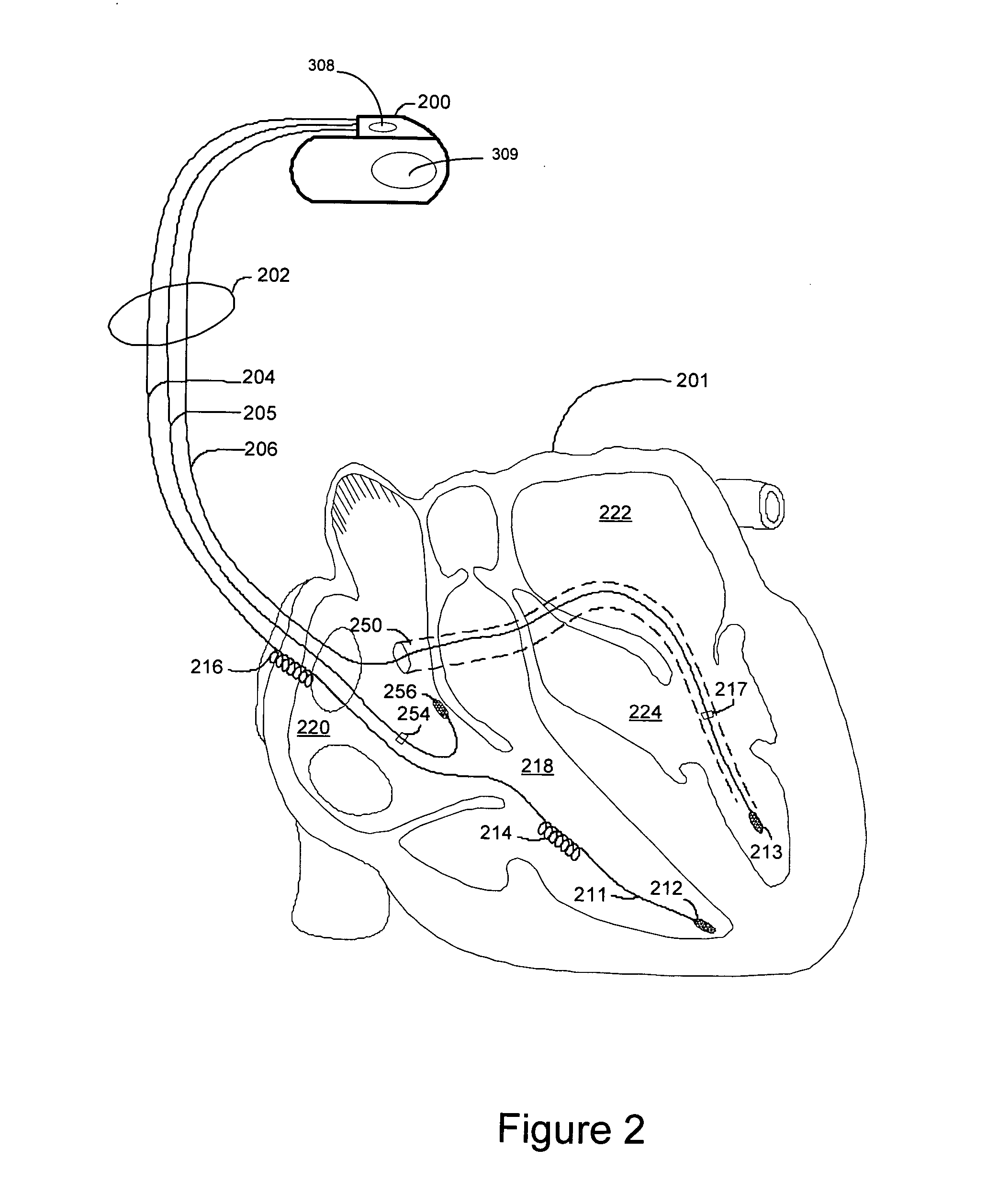 Adaptive safety pacing