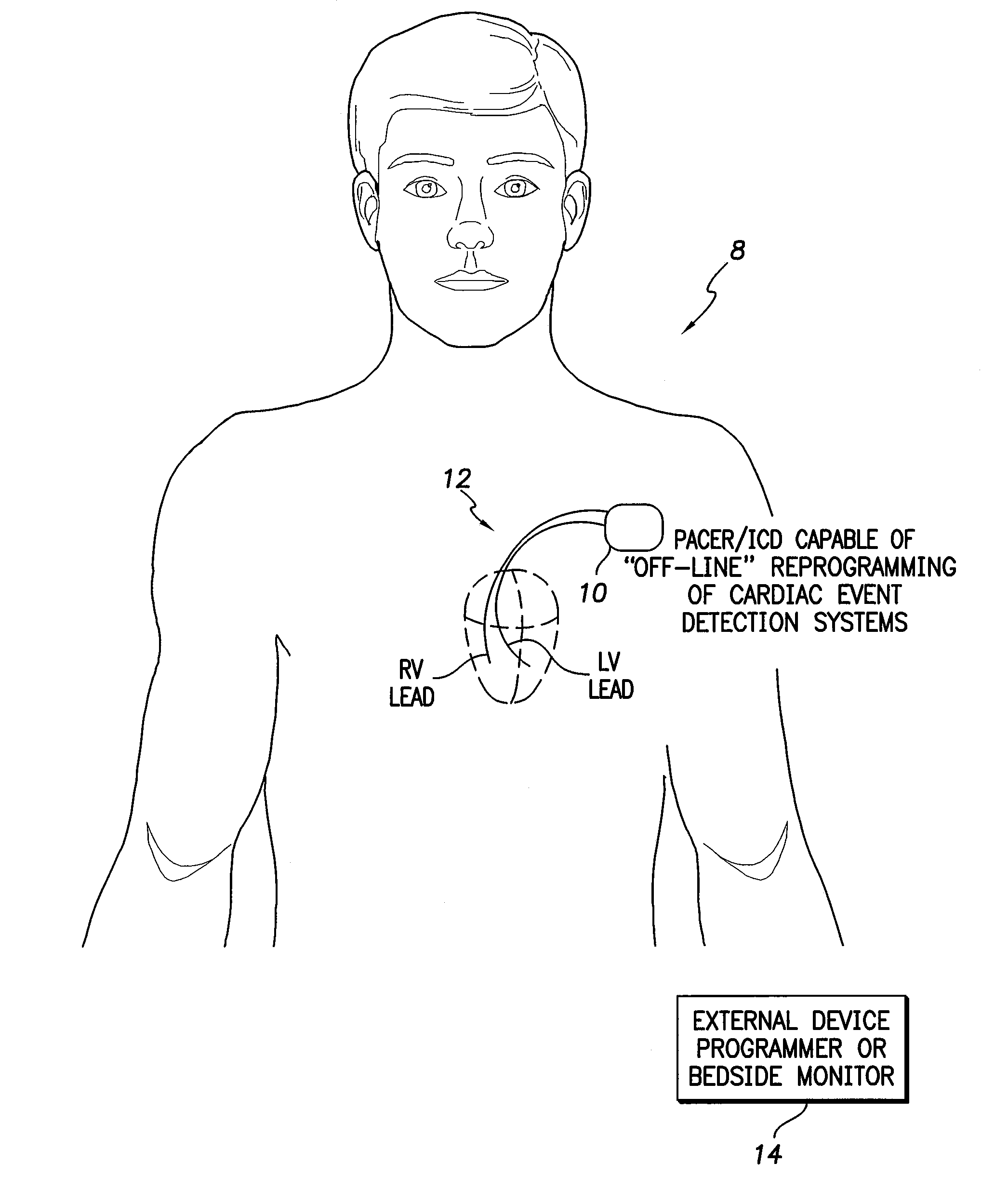 Systems and methods for off-line reprogramming of implantable medical device components to reduce false detections of cardiac events