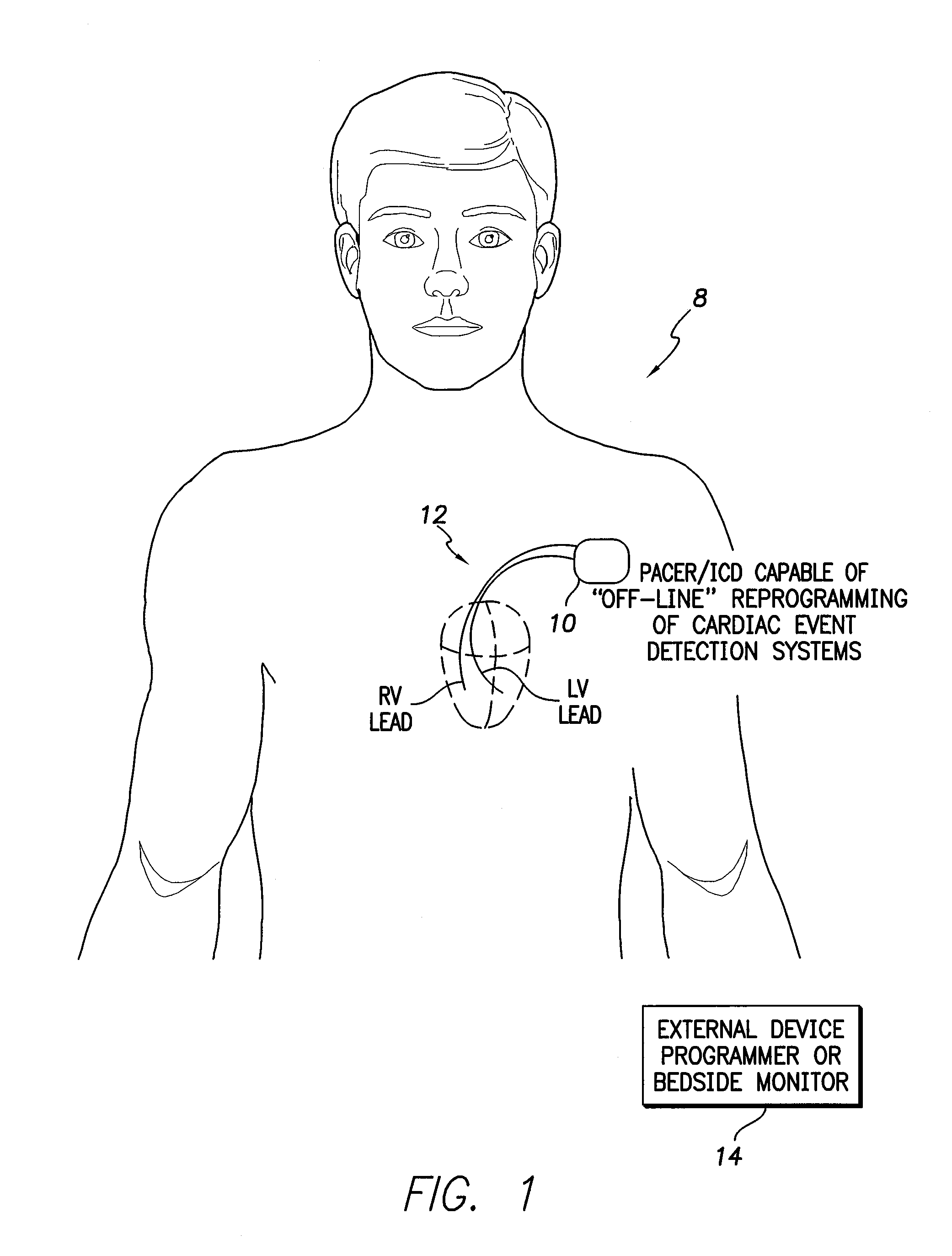 Systems and methods for off-line reprogramming of implantable medical device components to reduce false detections of cardiac events