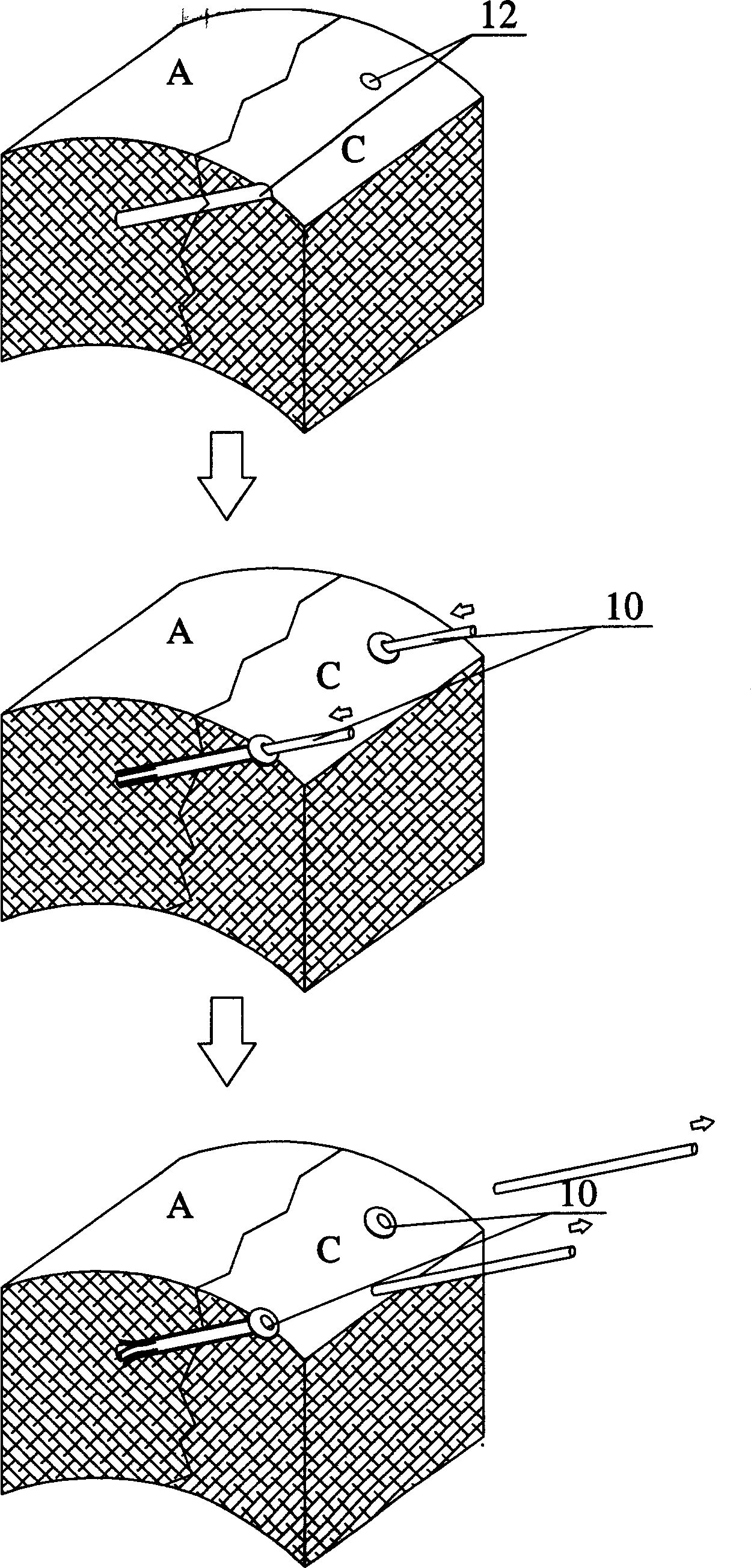 Skeleton fixation method for medical use, and its fixation nails