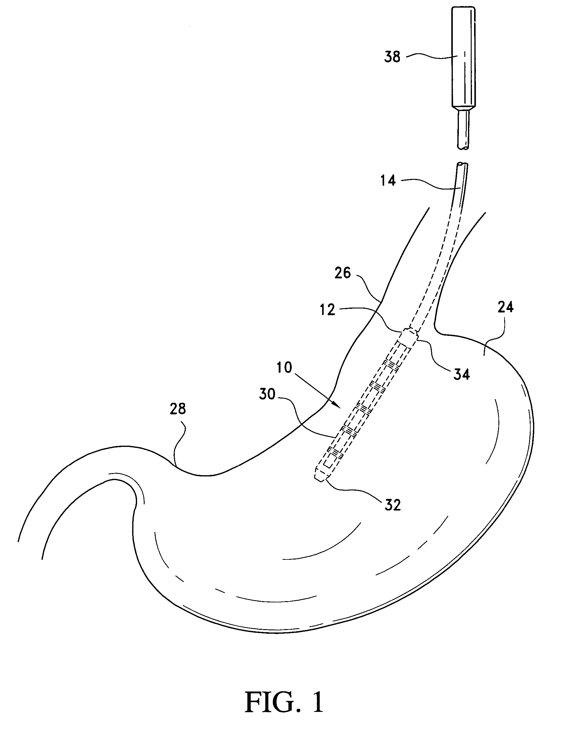 Method and apparatus for endoscopically performing gastric reduction surgery in a single step