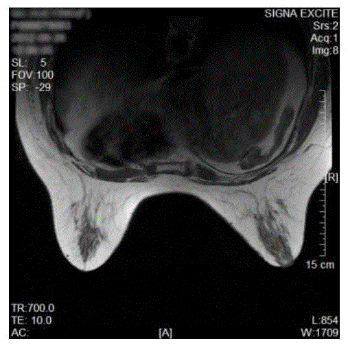 Ultra-wideband breast tumor imaging method based on magnetic resonance image compensation