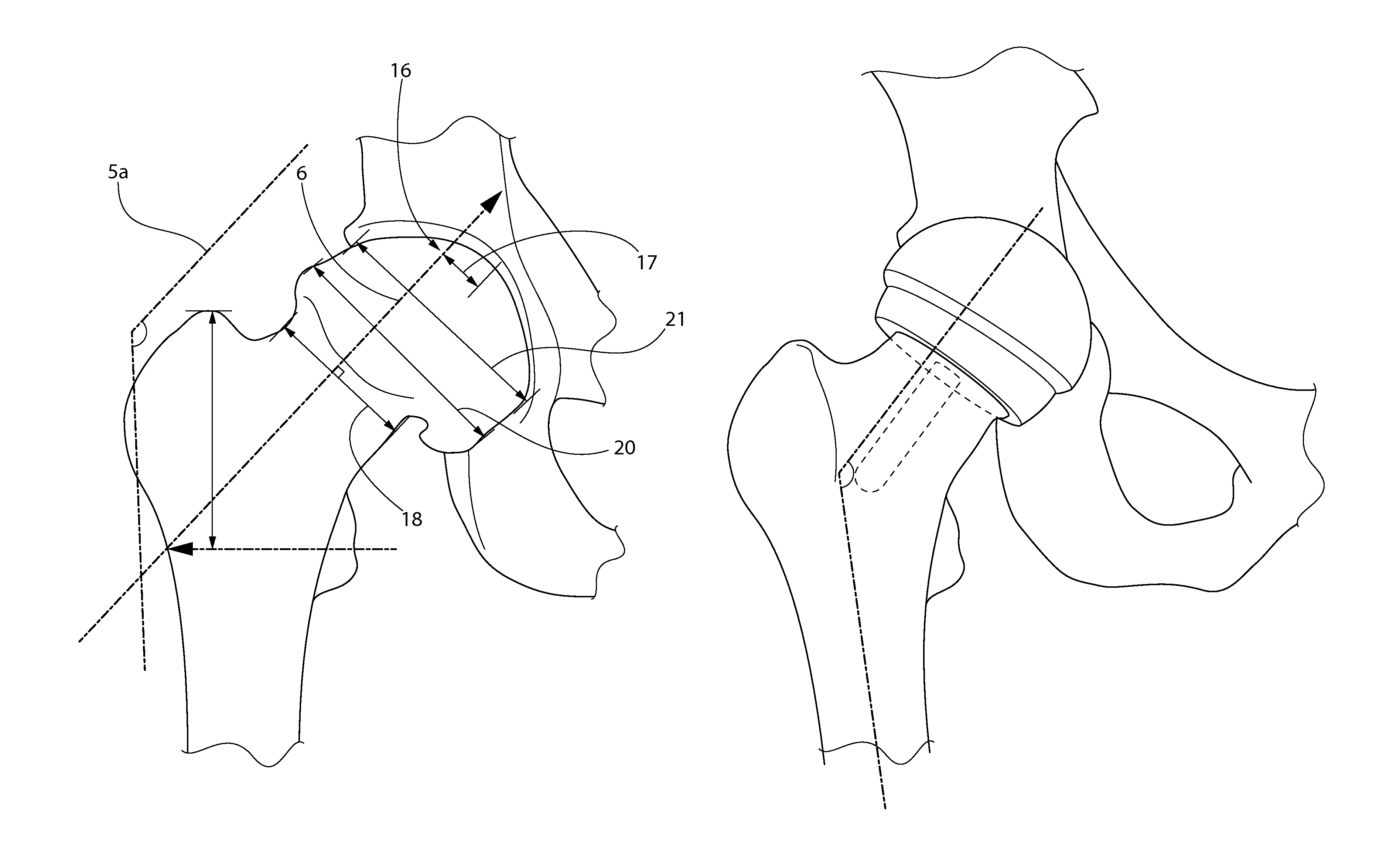 Measurement and placement techniques in hip resurfacing and the like