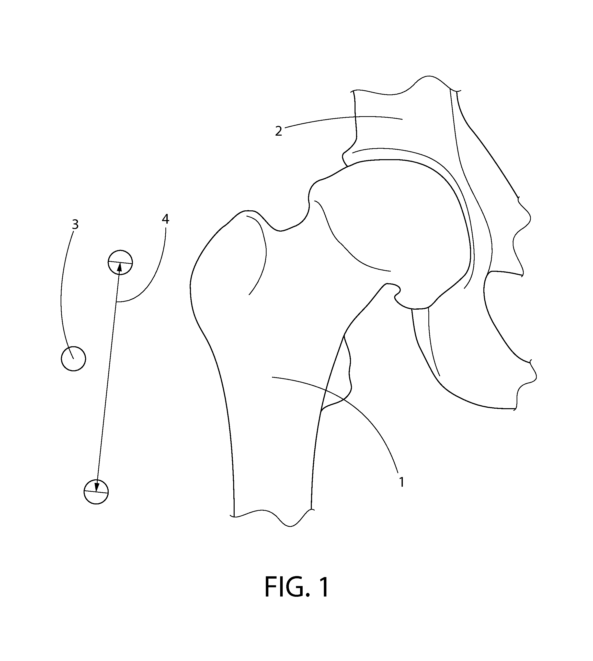 Measurement and placement techniques in hip resurfacing and the like