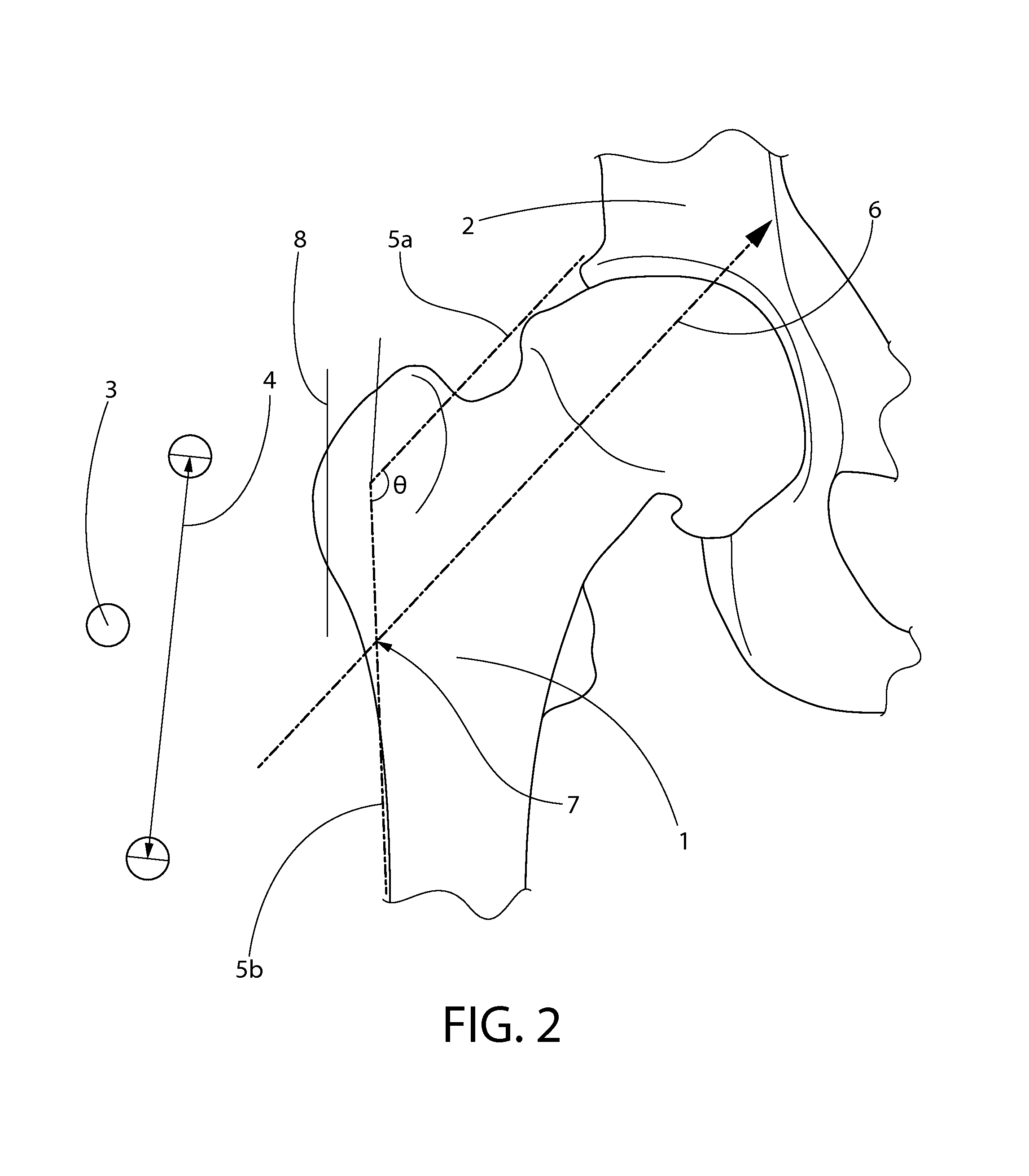 Measurement and placement techniques in hip resurfacing and the like