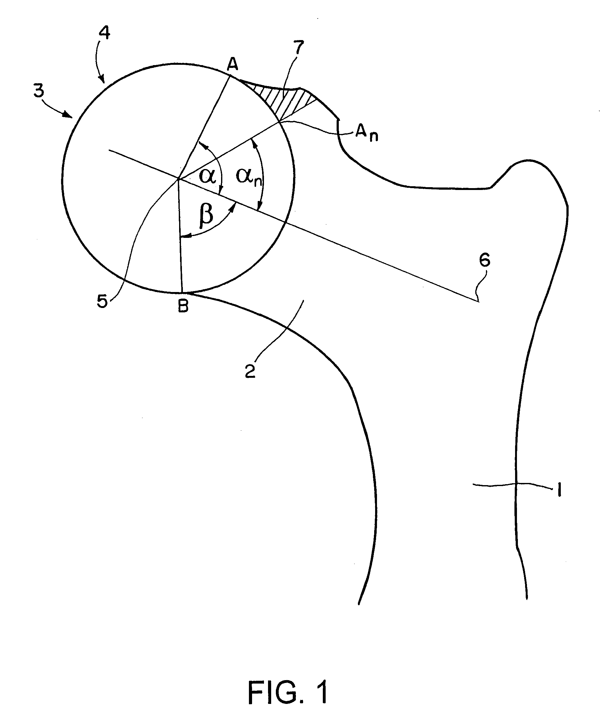 Computer-assisted planning method for correcting changes in the shape of joint bones