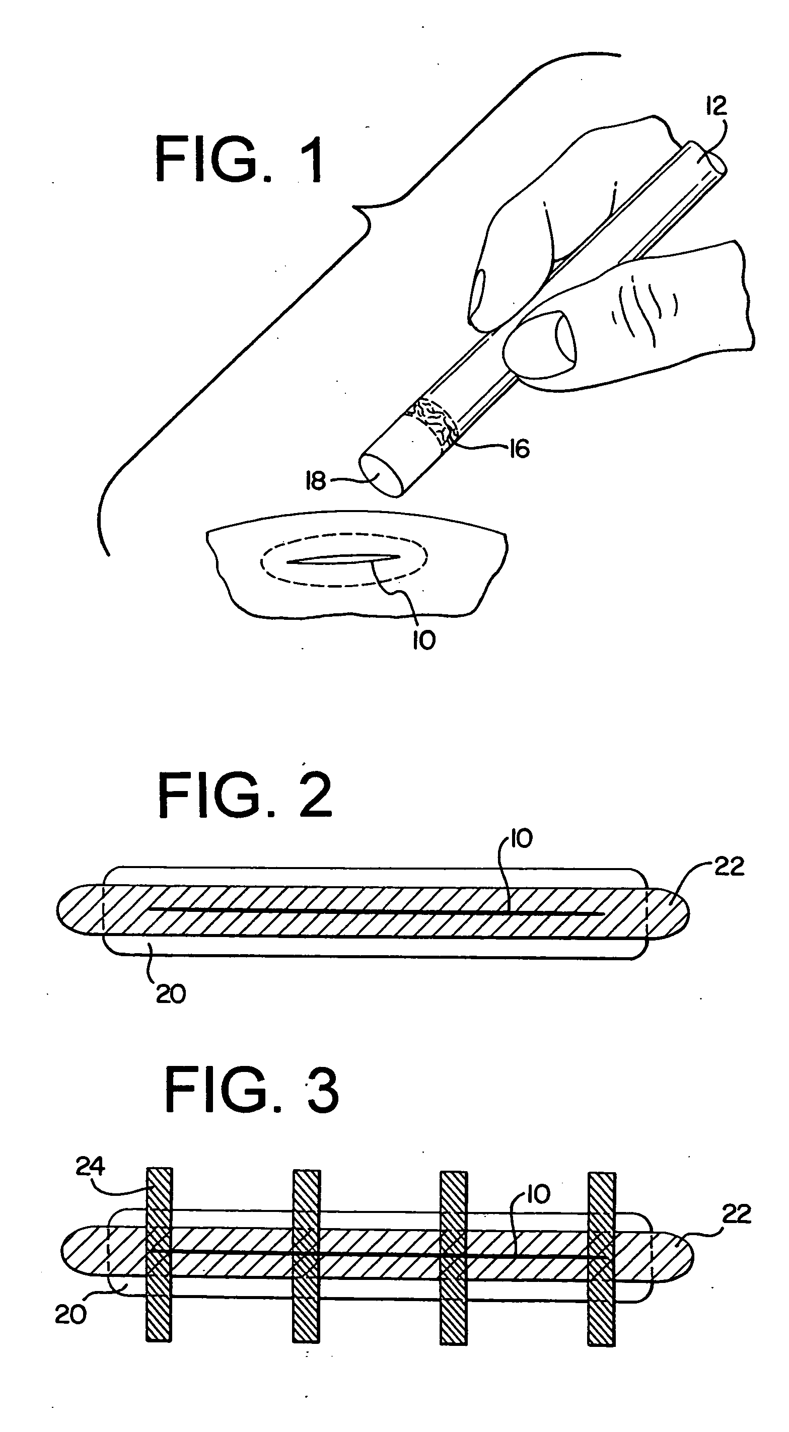 Dressing and method of treatment for a wound