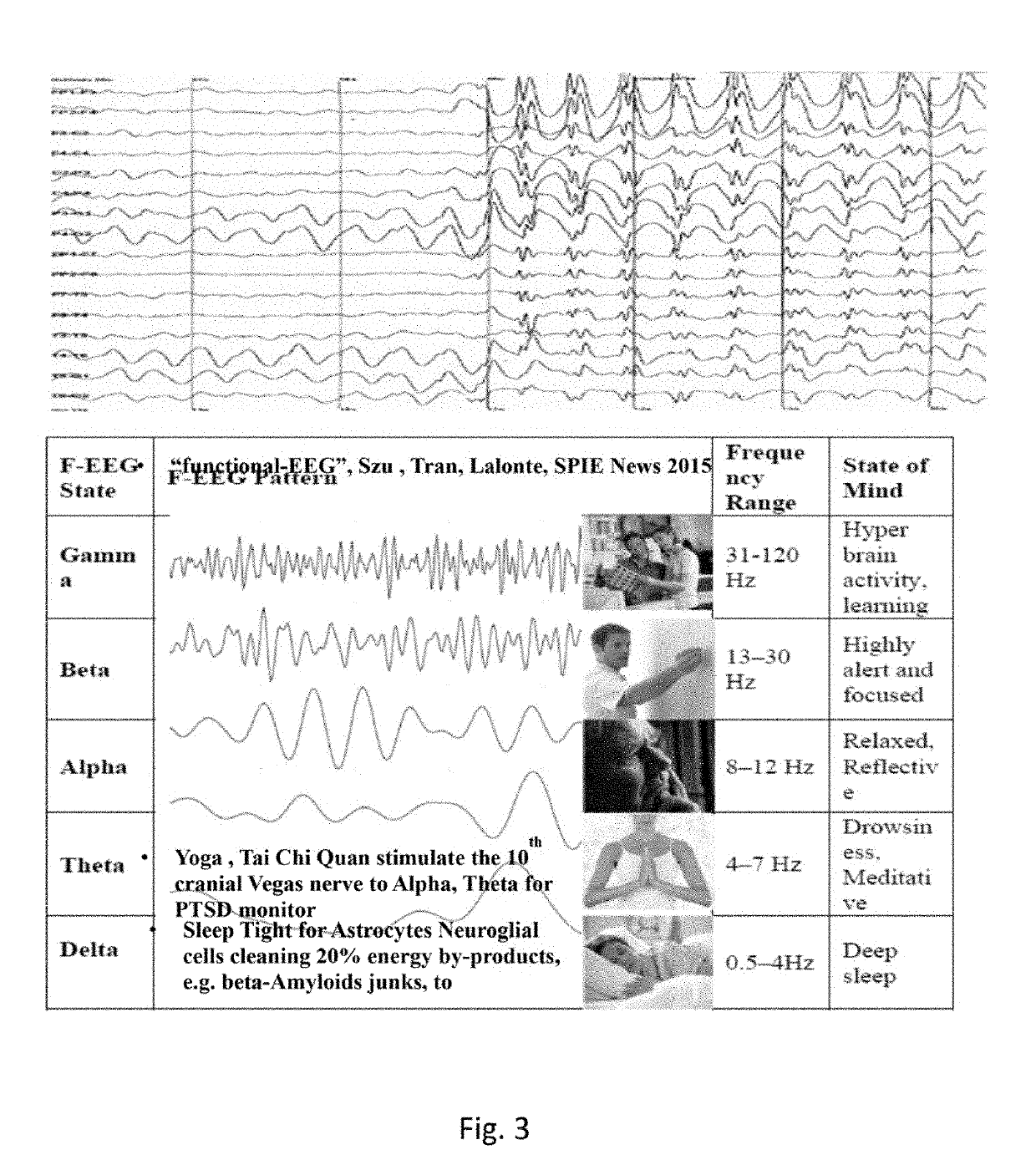 Using Helmholtz Minimum Free Energy Slopes to Define Glial Cells that Diagnose Brain Disorder