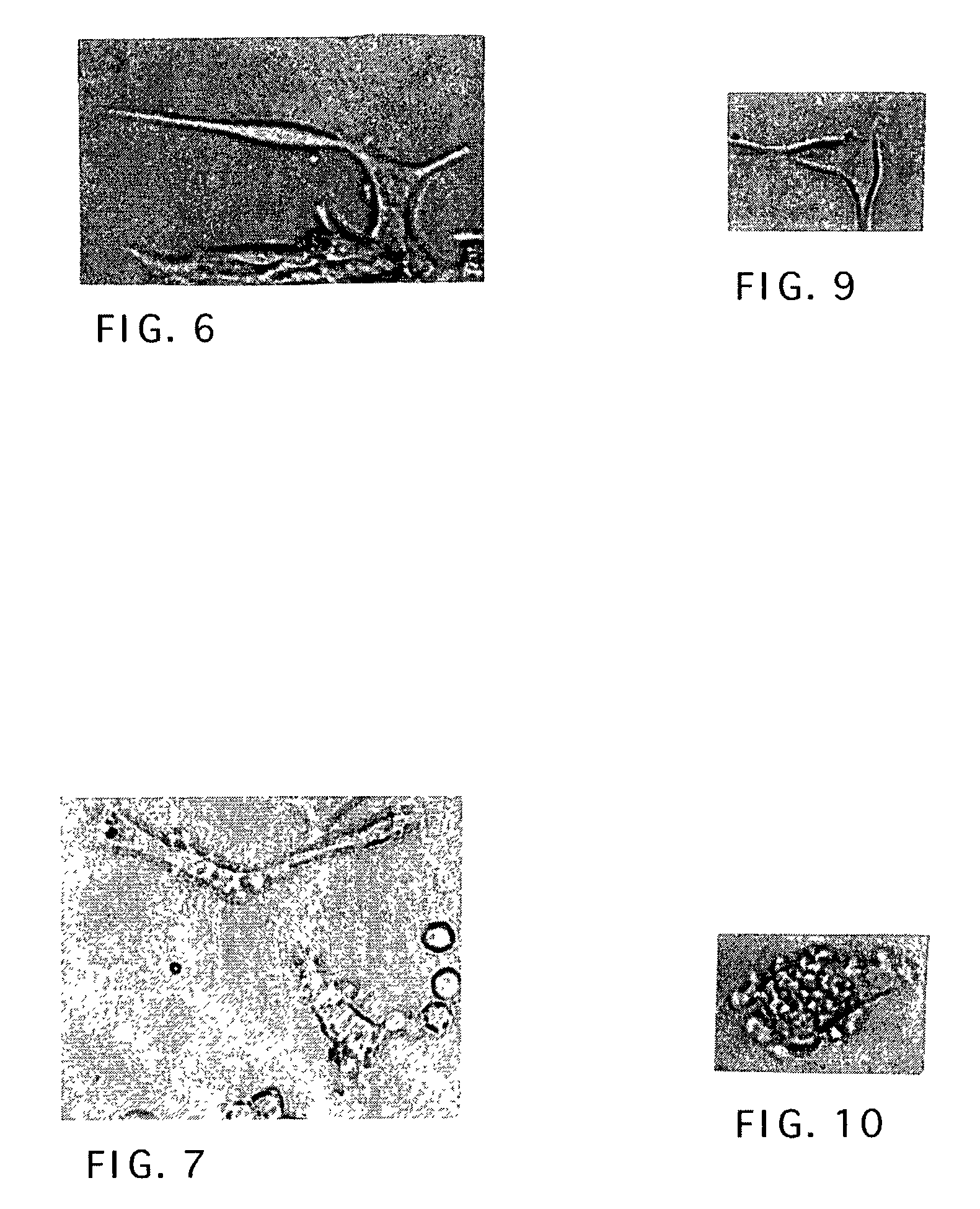 Alpha 2HS glycoprotein for treatment of cancer and a method for preparation thereof