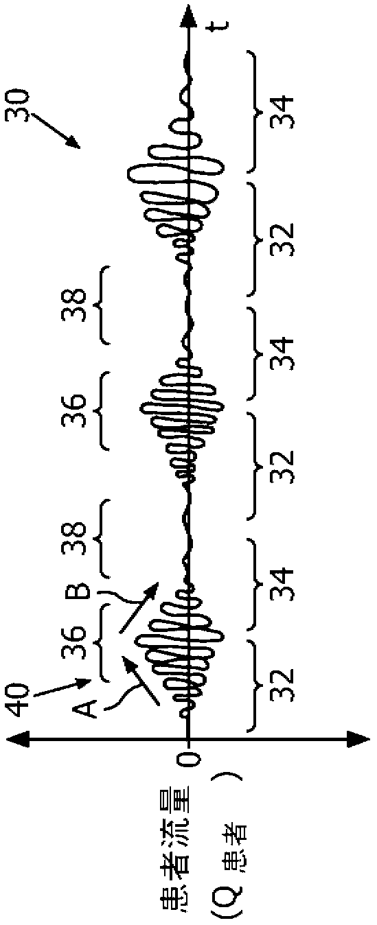 Servo ventilation using pressure drop from baseline