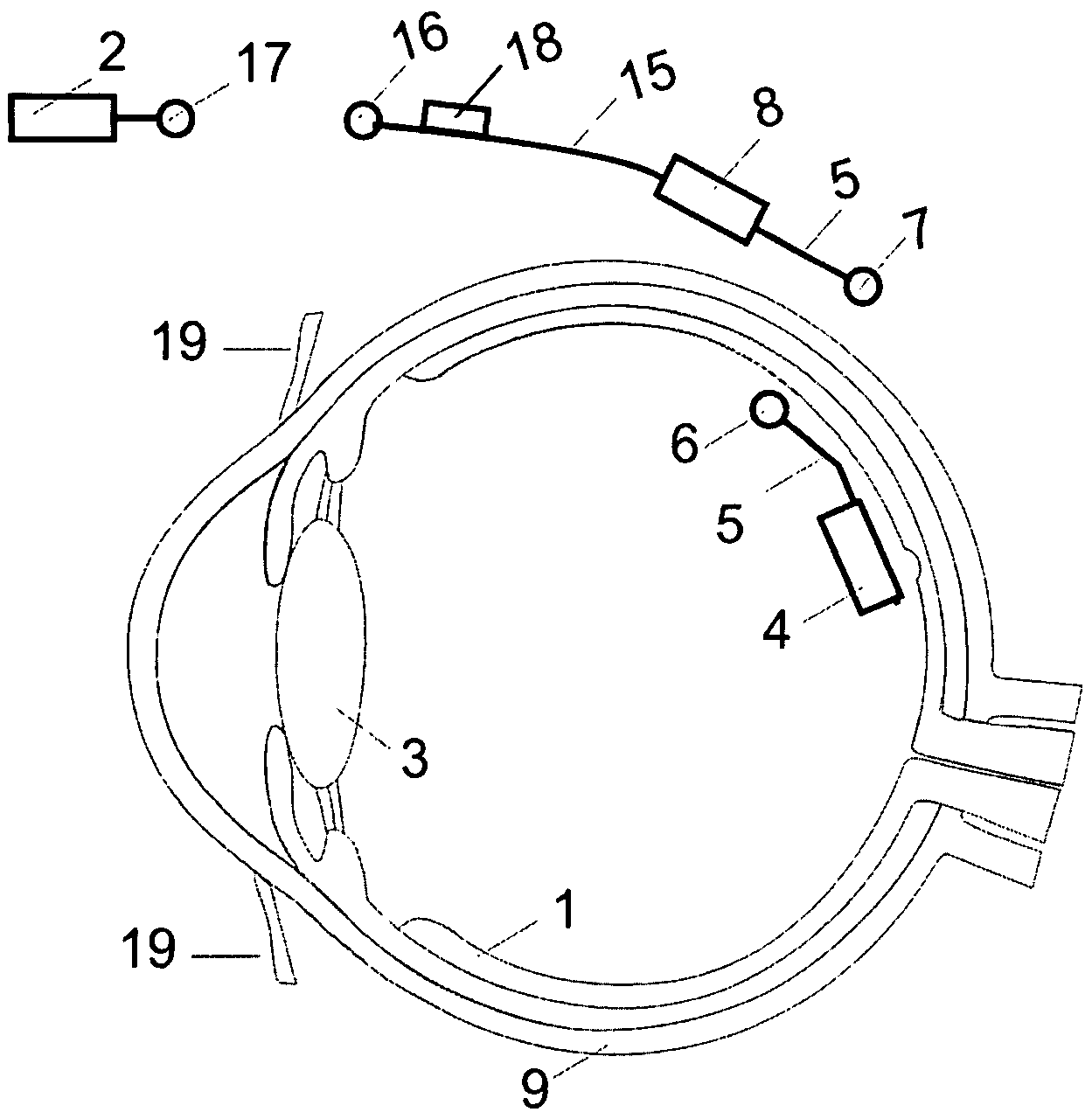 Retinal implant with improved implantation and working properties