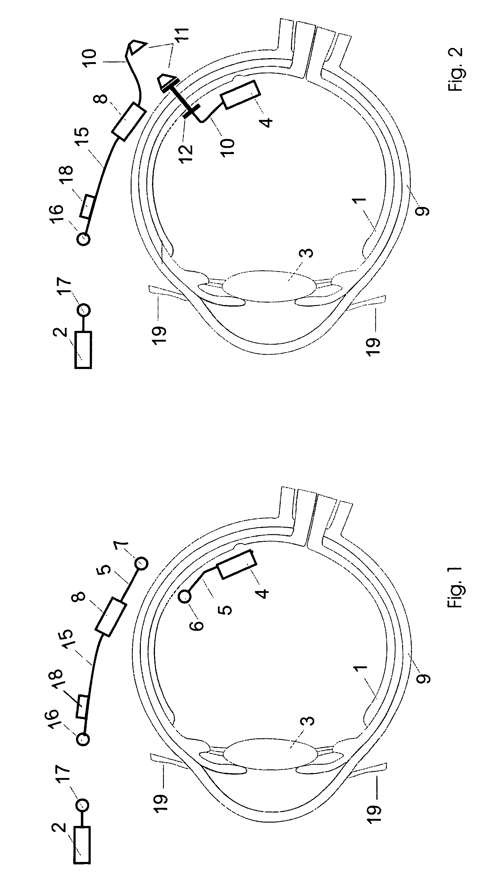 Retinal implant with improved implantation and working properties