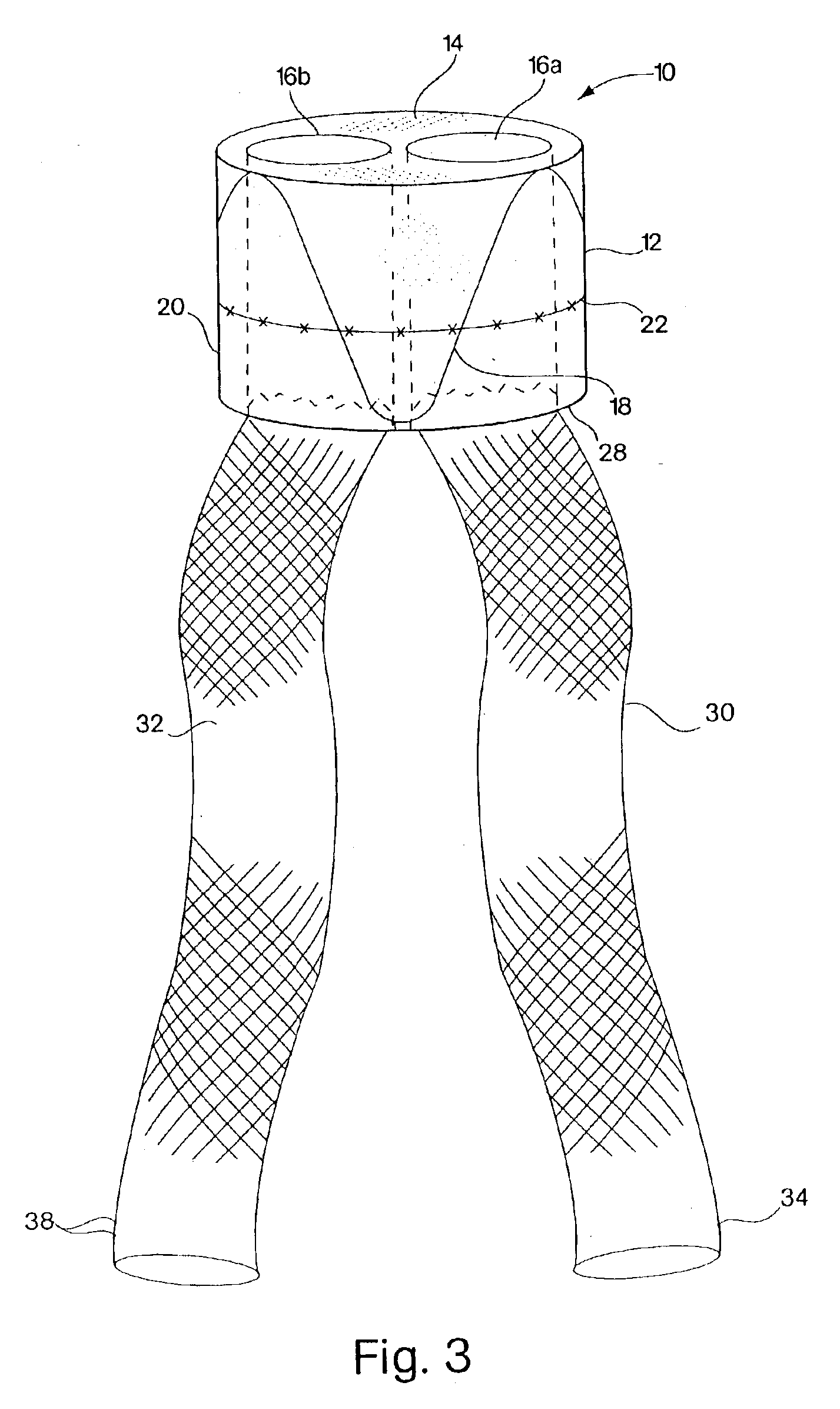 Short body endoprosthesis