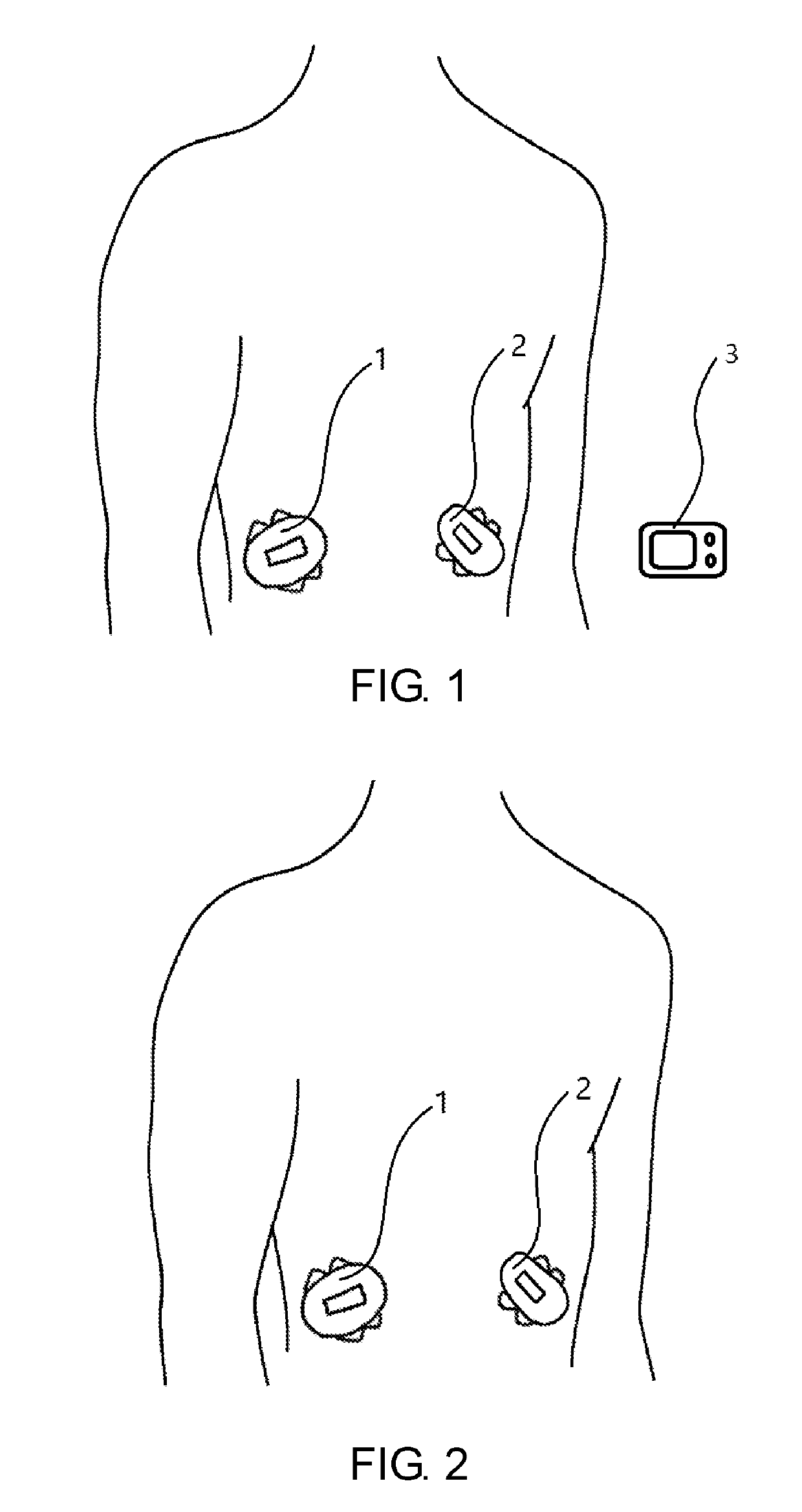 System and method for a closed loop control in an artificial pancreas