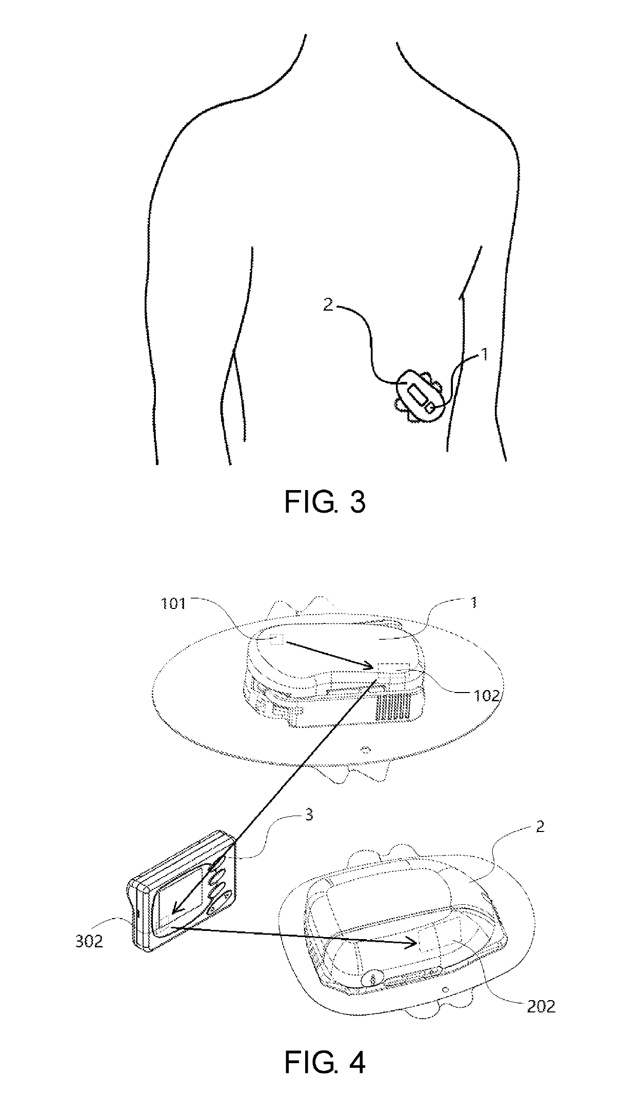 System and method for a closed loop control in an artificial pancreas