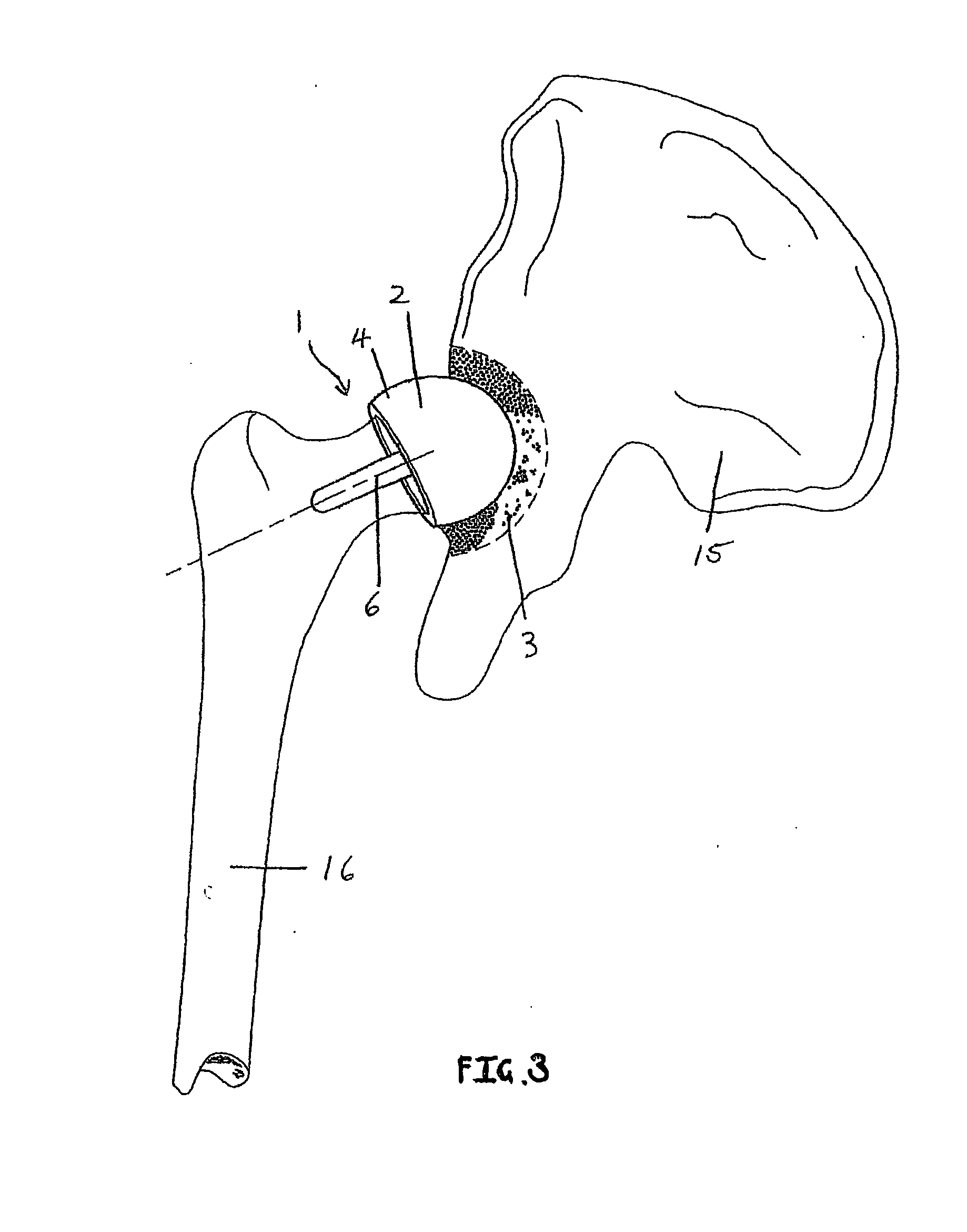 Hip Resurfacing Component