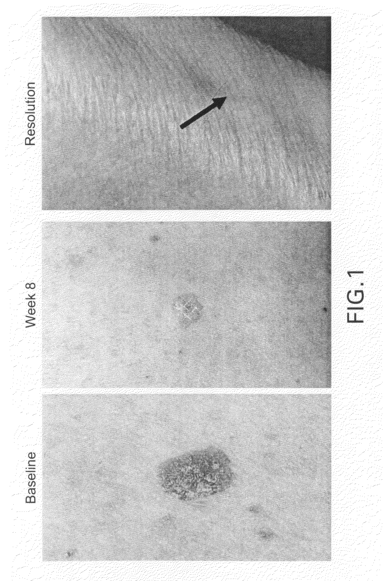 Methods for the treatment of scleroderma using 1-oxo-2-(2,6-dioxopiperidin-3-yl)-4-methylisoindoline