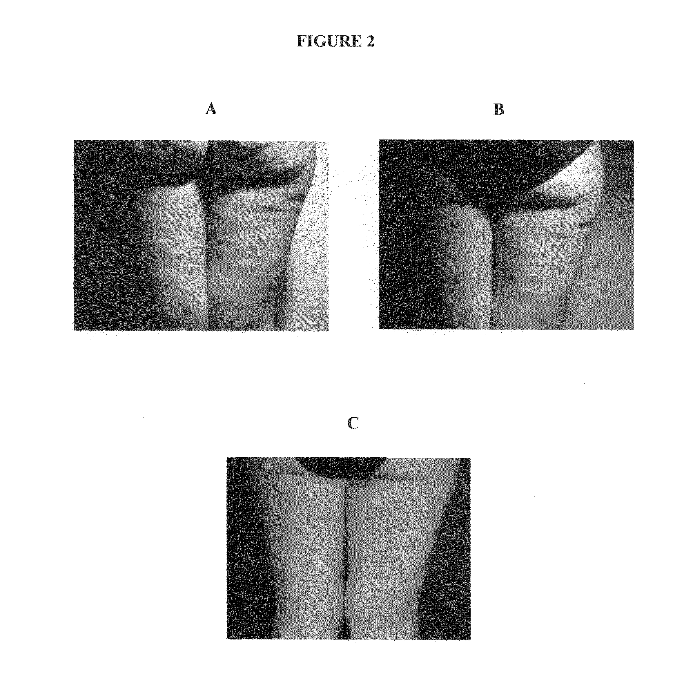 Pdt treatment method for cellulites and cosmetic use