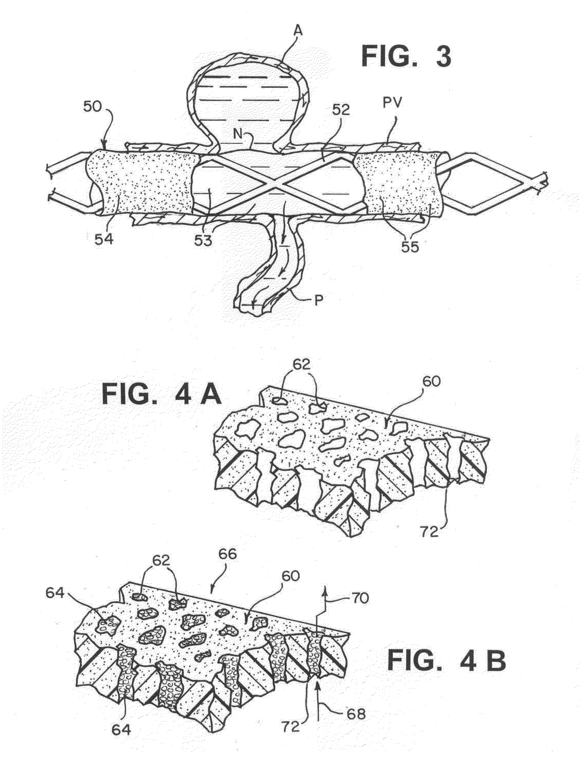 Method of fabricating modifiable occlusion device